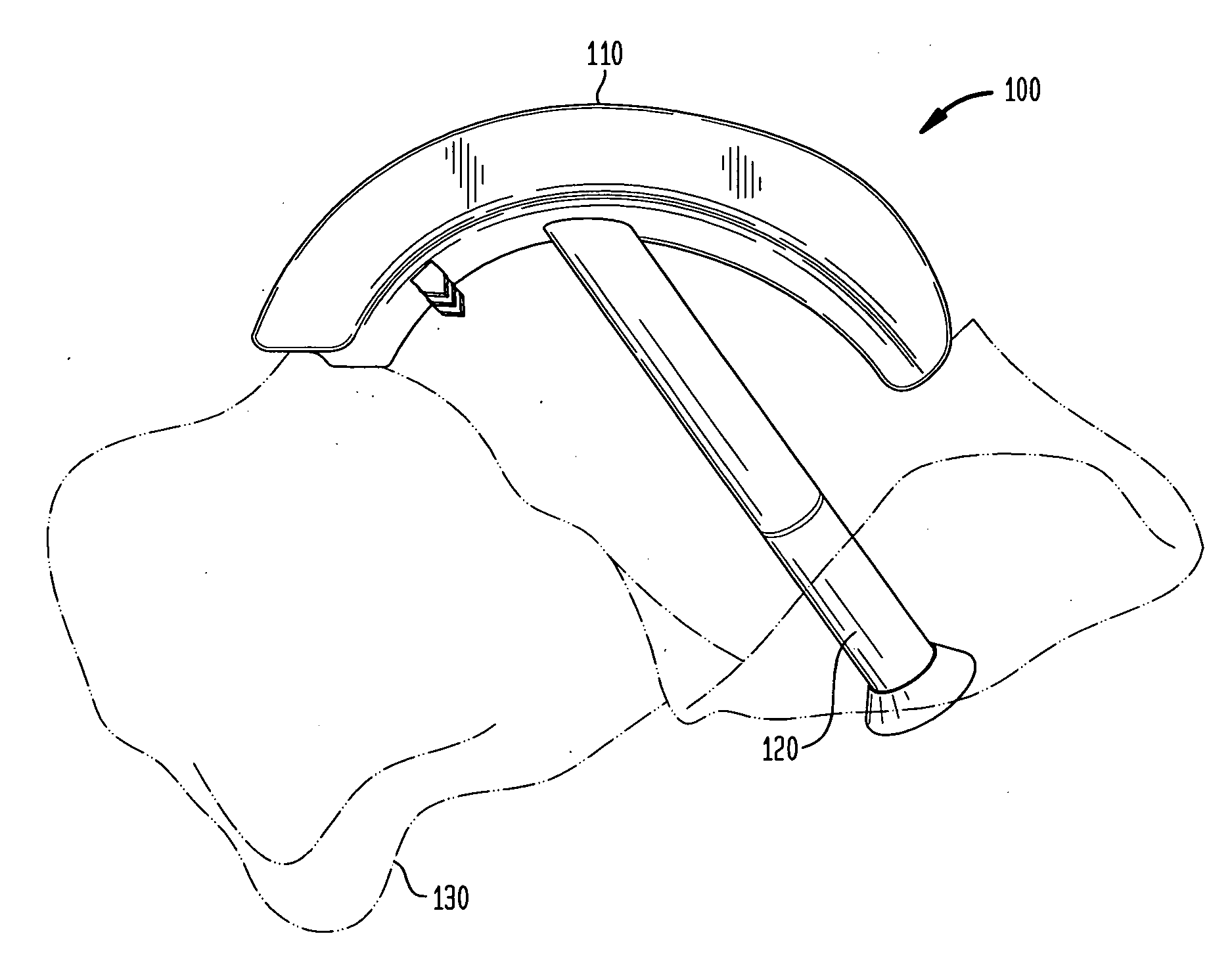 System and method for joint resurfacing with dynamic fixation