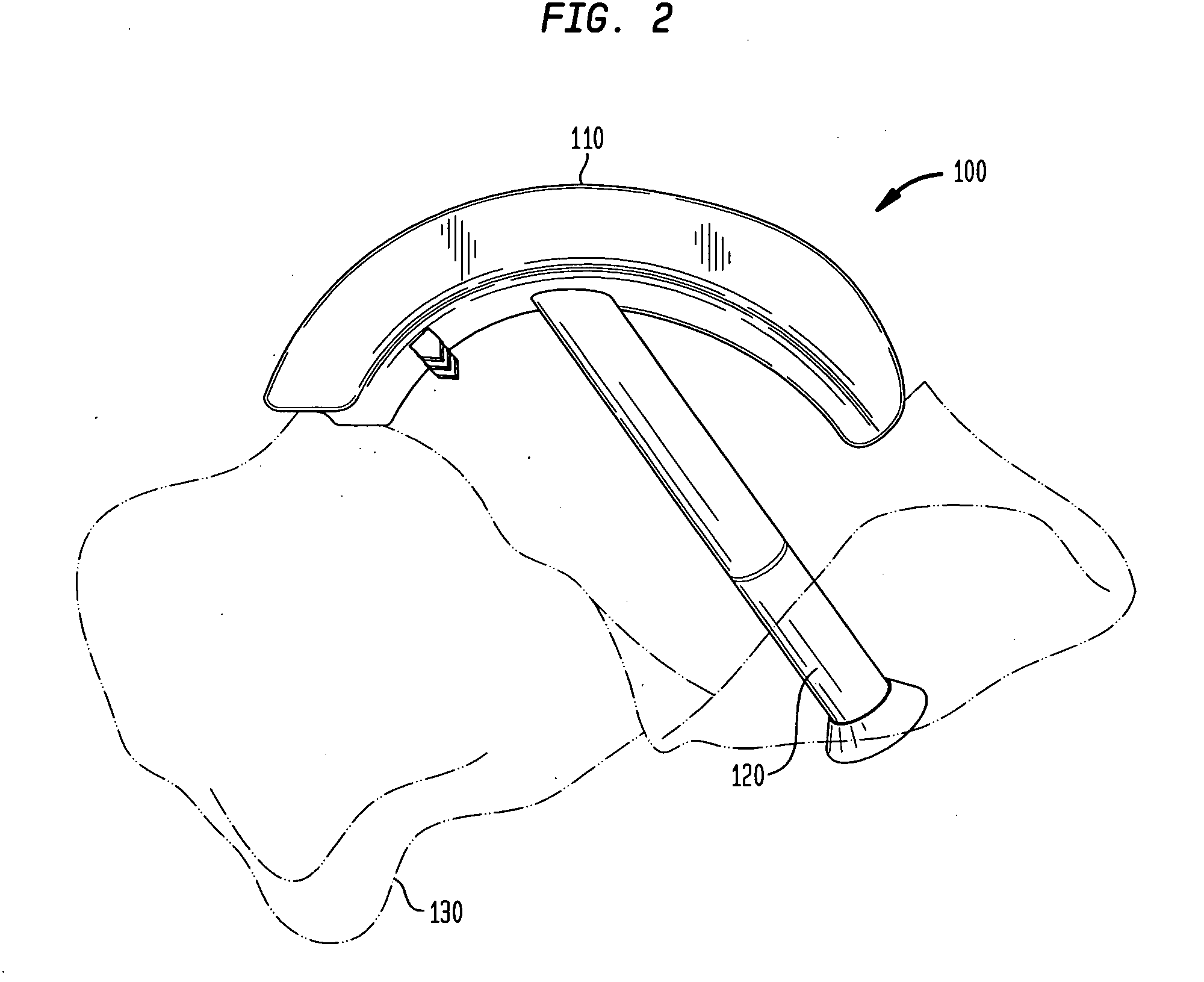 System and method for joint resurfacing with dynamic fixation