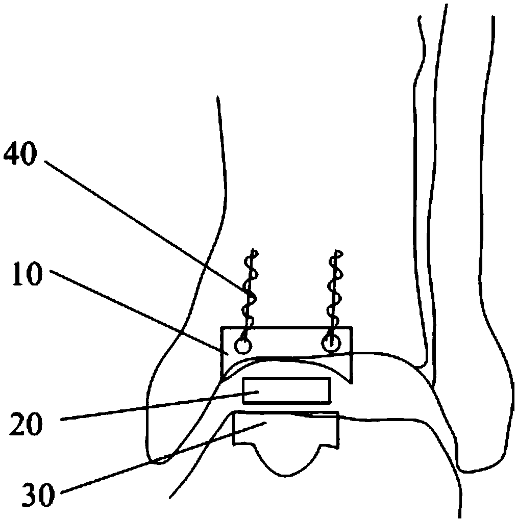 Single ankle joint surface replacement system