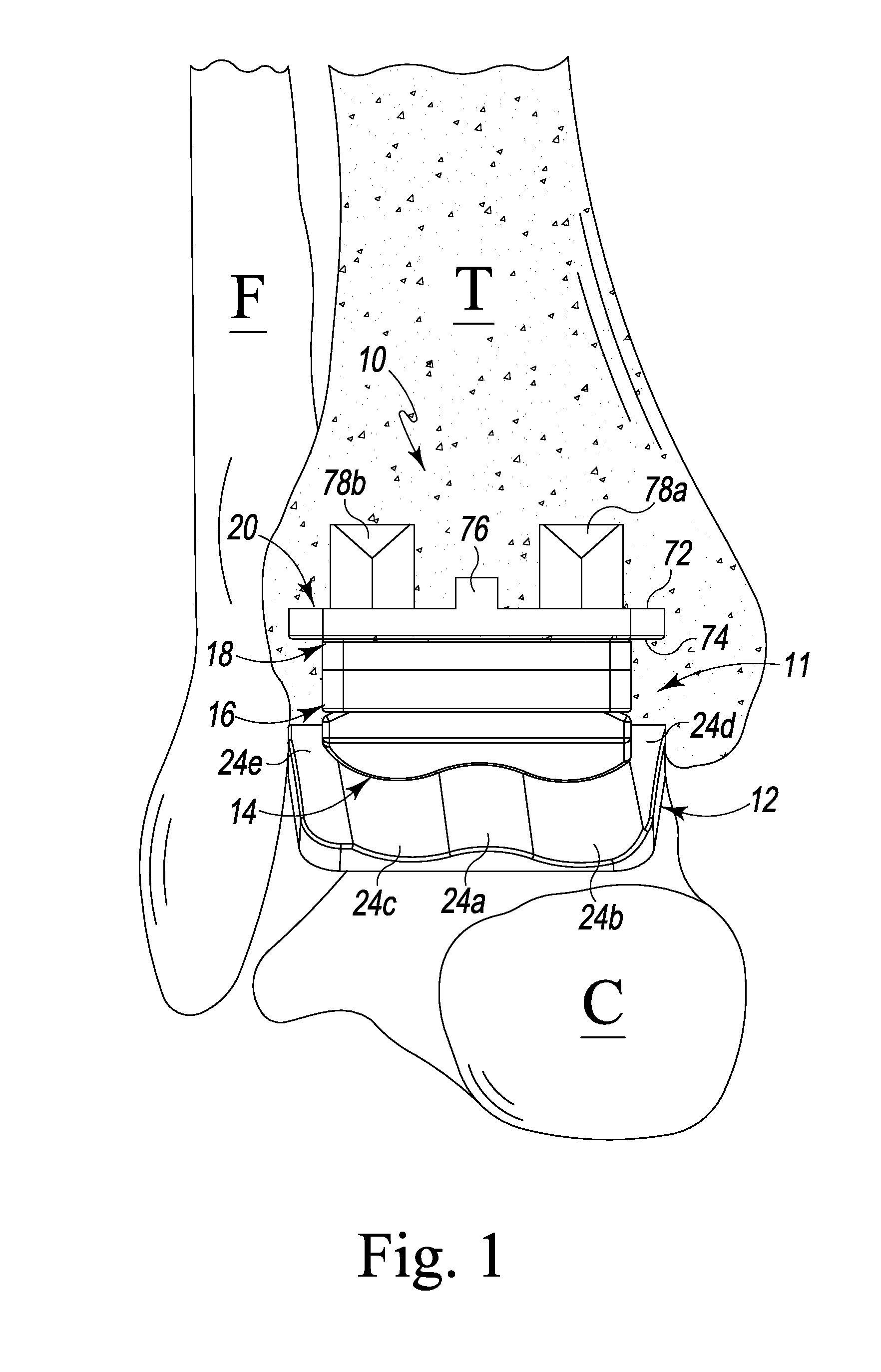 Prosthetic device with multi-axis dual bearing assembly and methods for resection