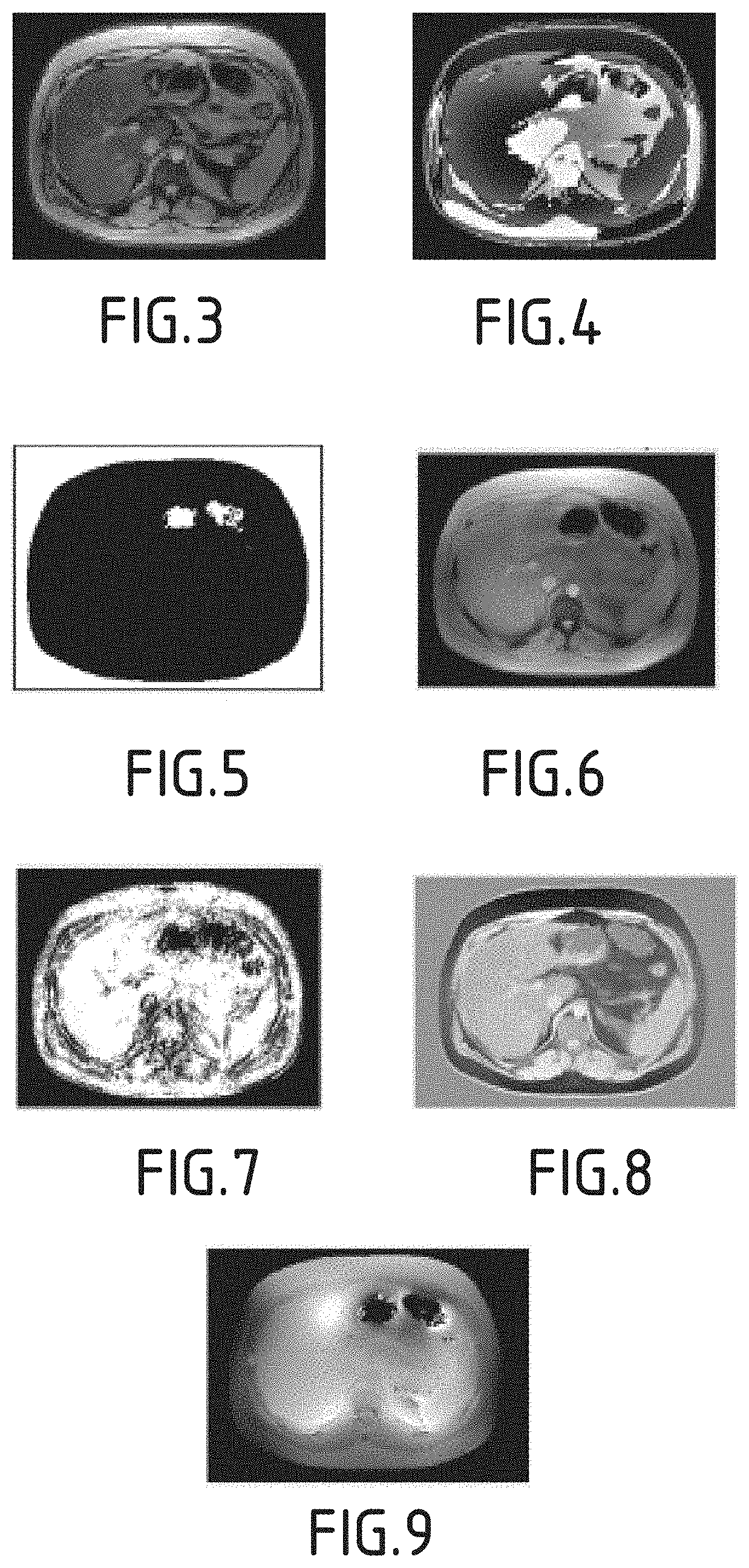 Method for post-processing liver MRI images to obtain a reconstructed map of the internal magnetic susceptibility