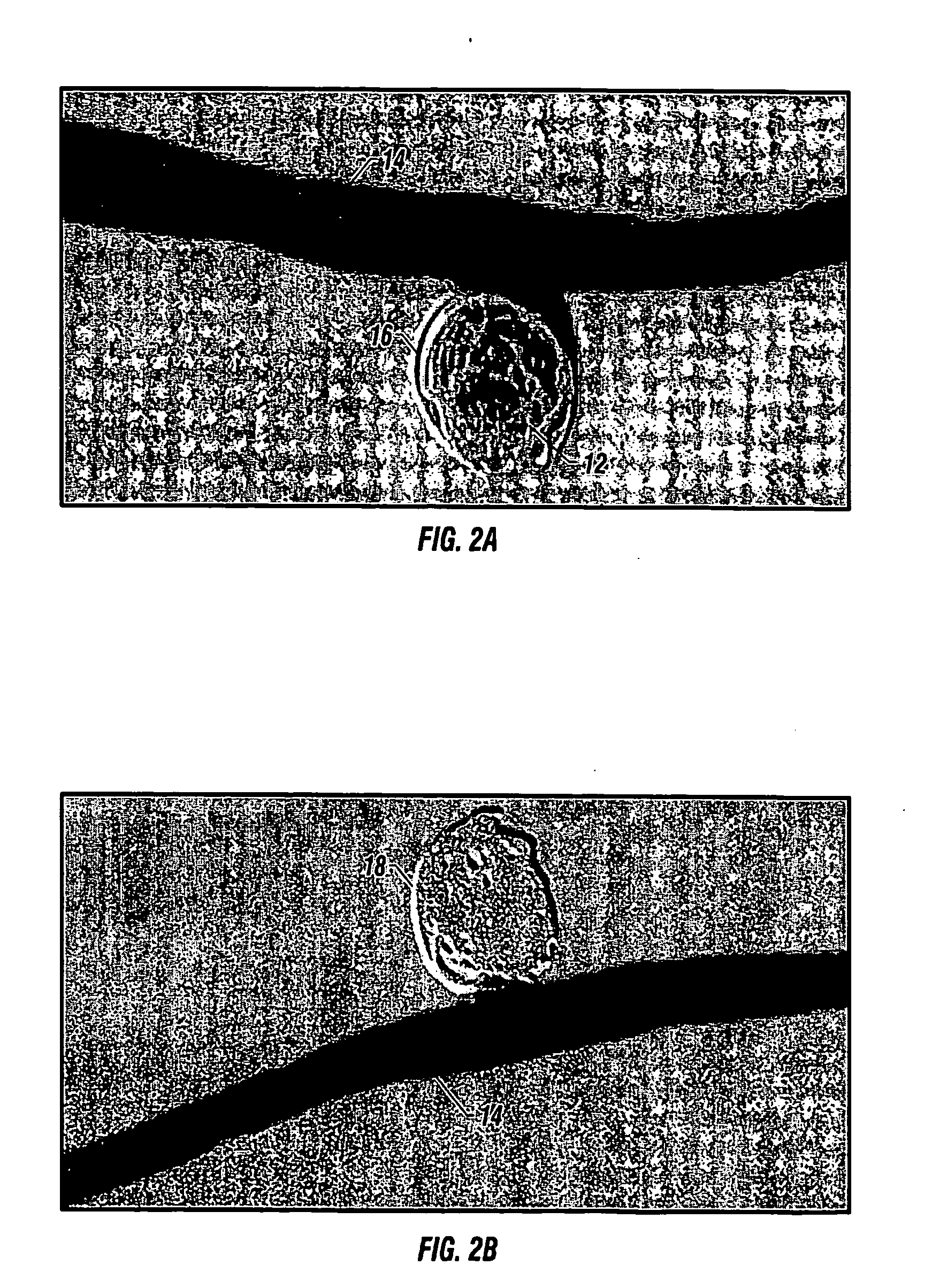 Bioabsorbable polymeric implants and a method of using the same to create occlusions