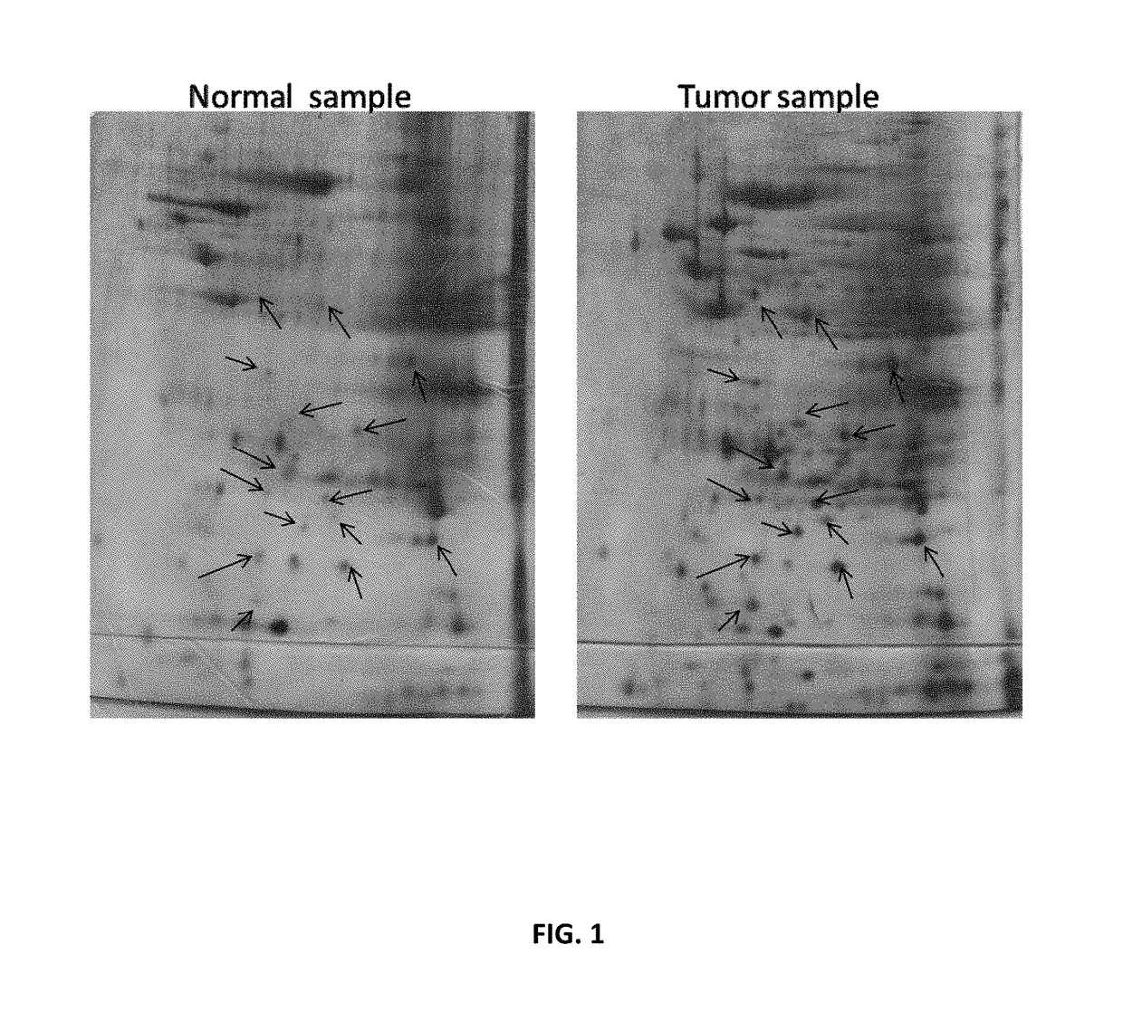 Specific biomarker set for non-invasive diagnosis of liver cancer