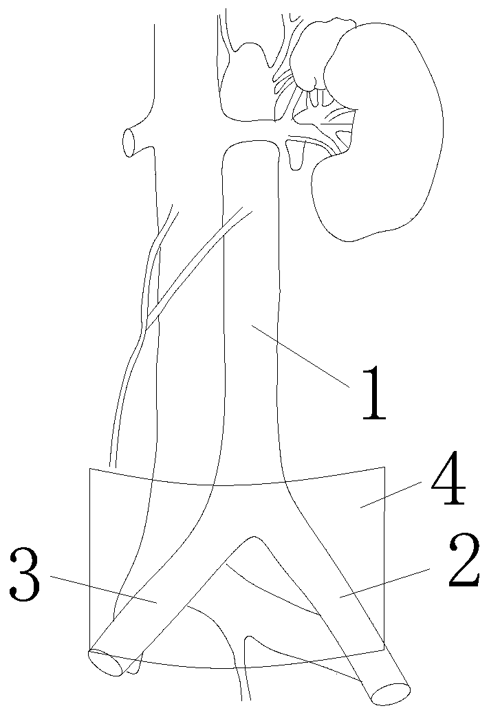 Hemostatic device for prehospital incompressible trunk bleeding