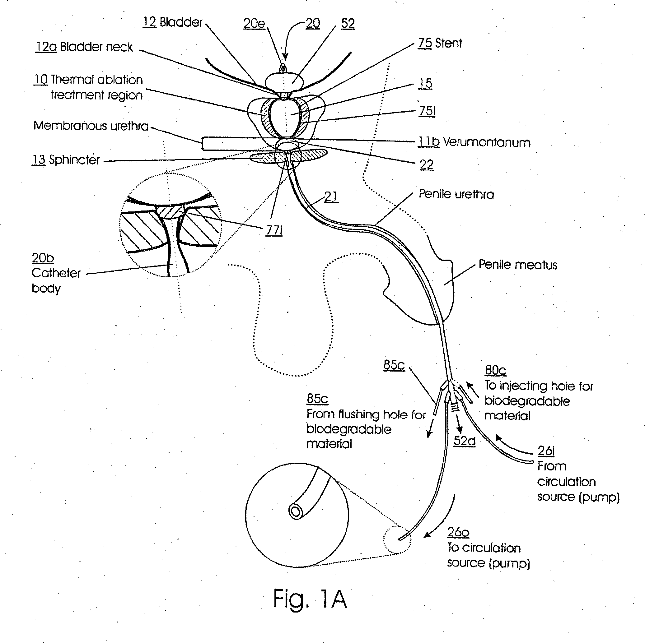 Method for treating the prostate and inhibiting obstruction of the prostatic urethra using biodegradable stents
