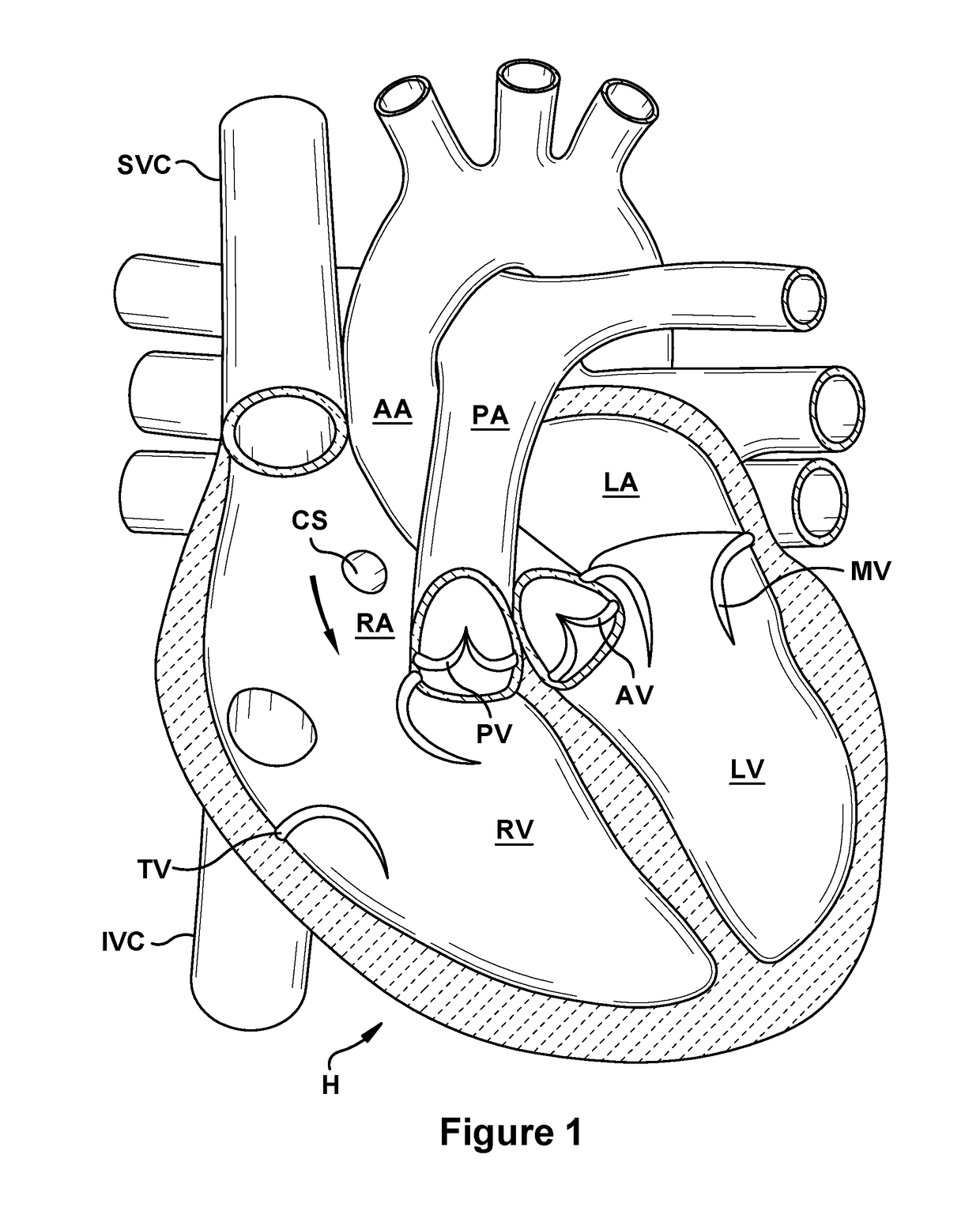 Native valve repair devices and procedures