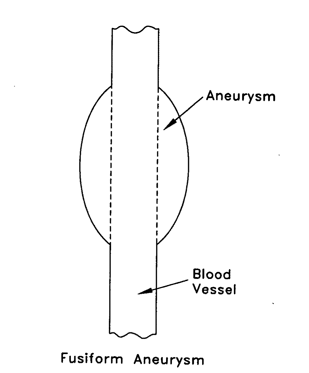 Method and apparatus for sealing an opening in the side wall of a body lumen, and/or for reinforcing a weakness in the side wall of a body lumen, while maintaining substantially normal flow through the body lumen
