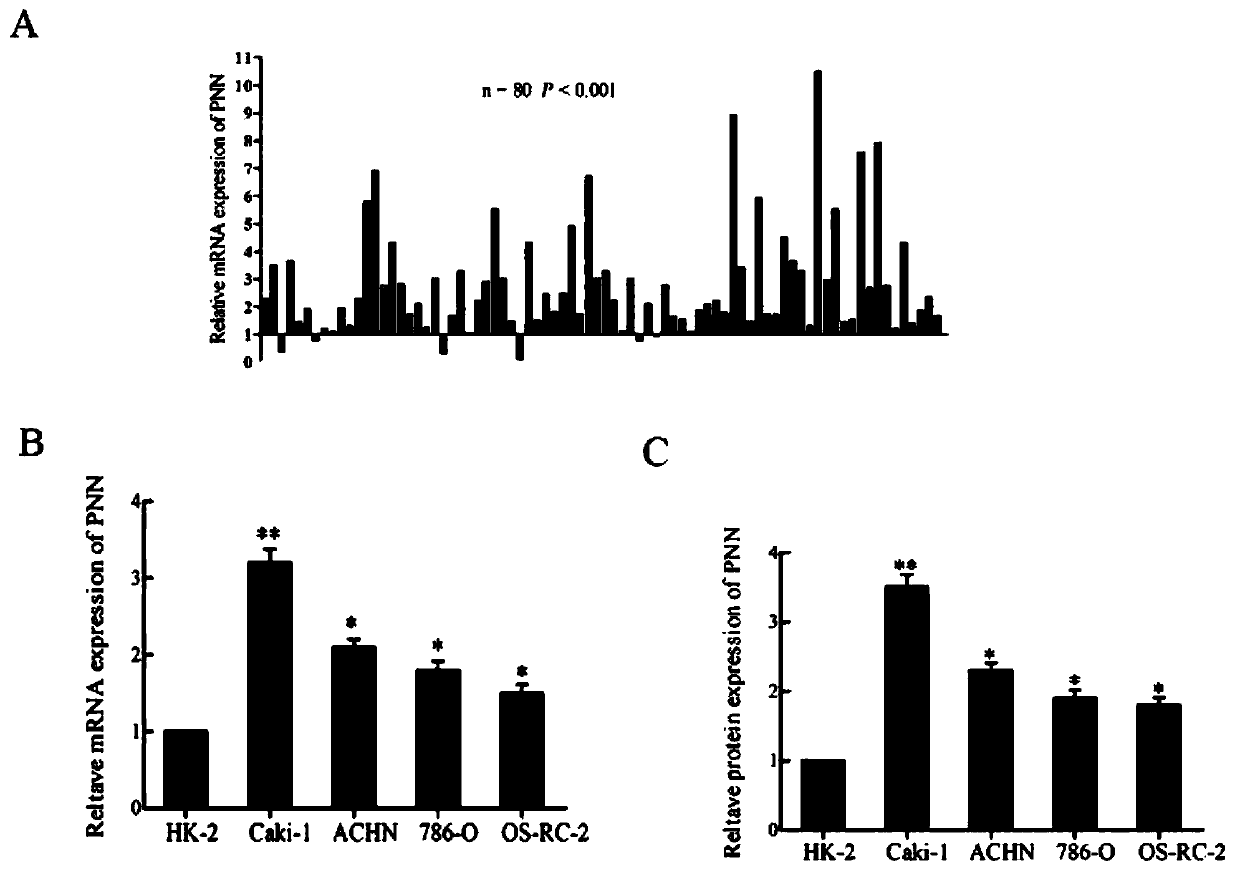 Application of pinin (PNN) inhibitor to preparation of drug for reversing drug resistance of transferable renal carcinoma cells to sunitinib