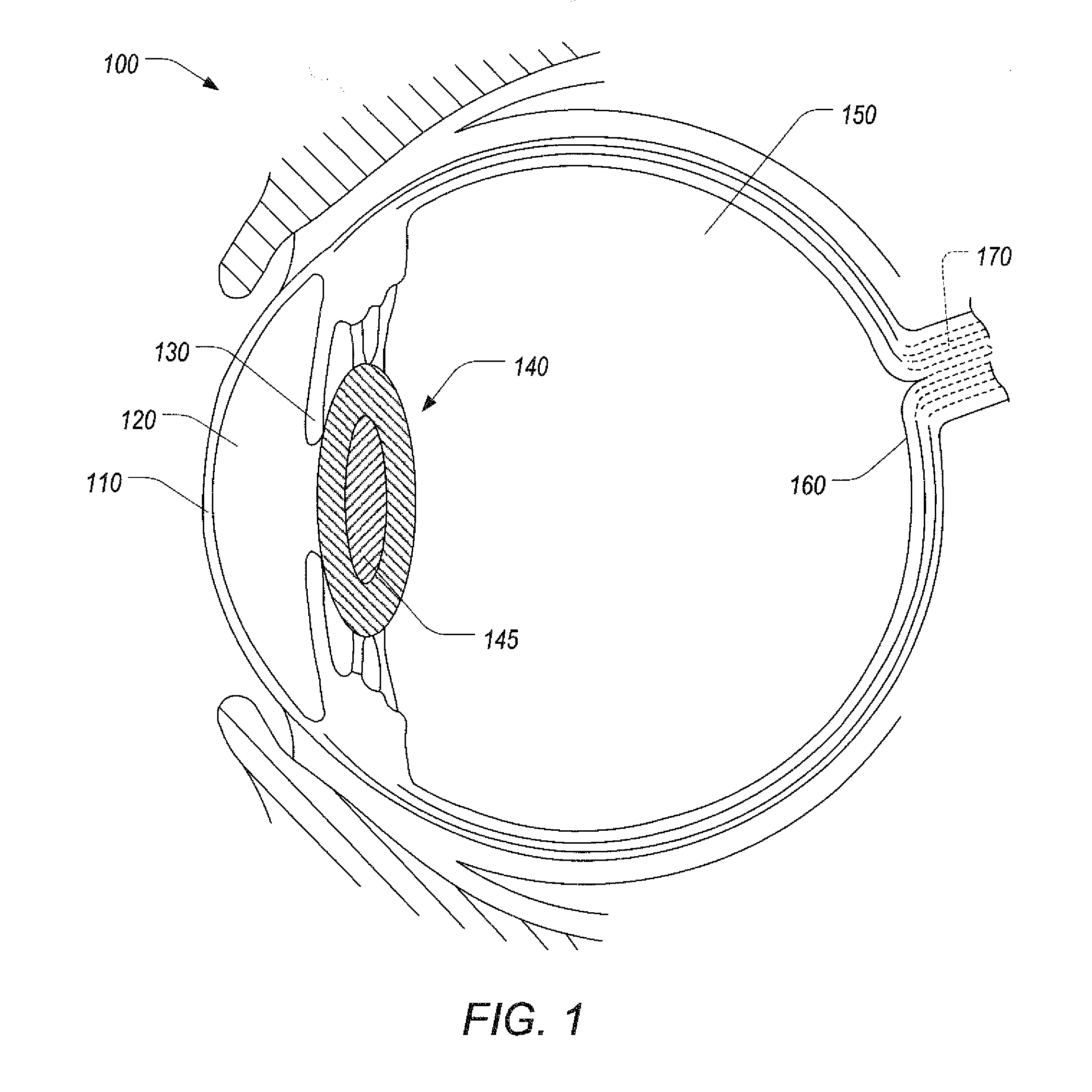 Varying a numerical aperture of a laser during lens fragmentation in cataract surgery