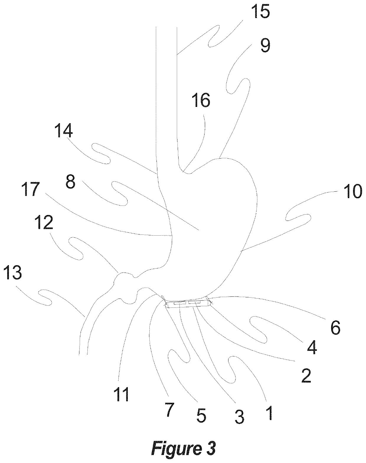 Method, apparatus, surgical technique, and optimal stimulation parameters for noninvasive & minimally invasive autonomic vector neuromodulation for the treatment of obesity, cardiac disease, pulmonary disorders, hypertension, and other conditions