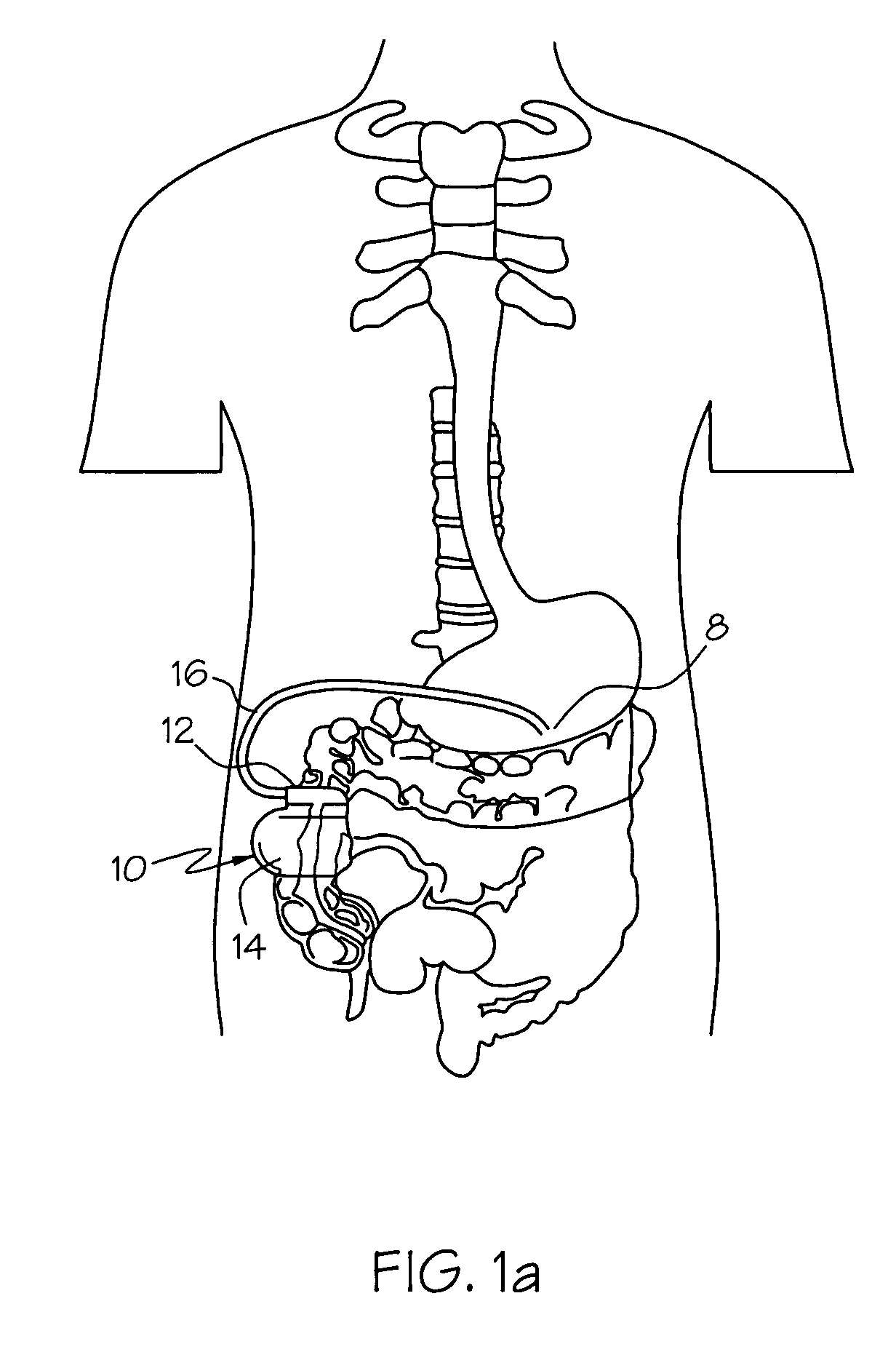 Gastro-electric stimulation for reducing the acidity of gastric secretions or reducing the amounts thereof