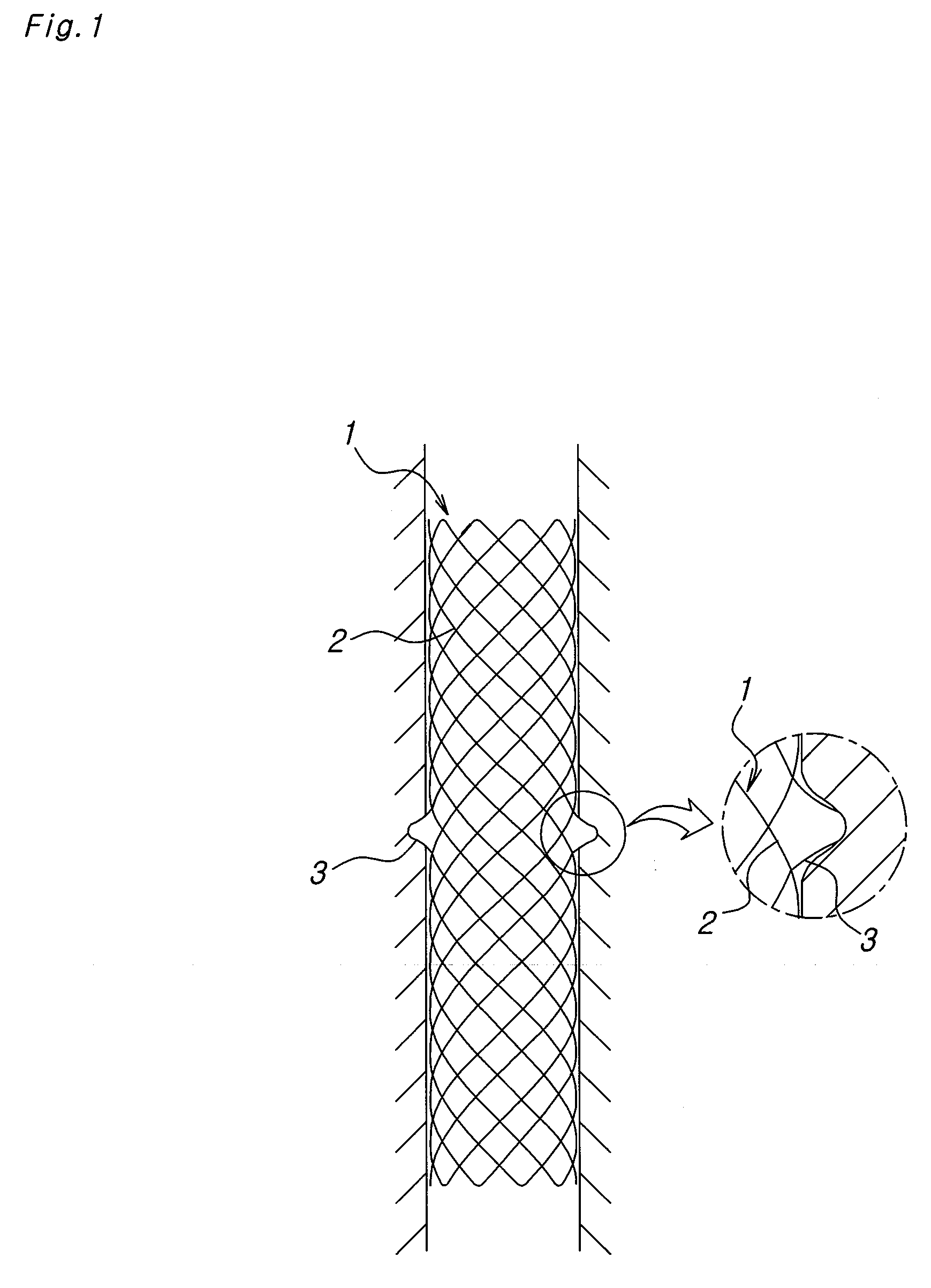 Biodegradable double stent