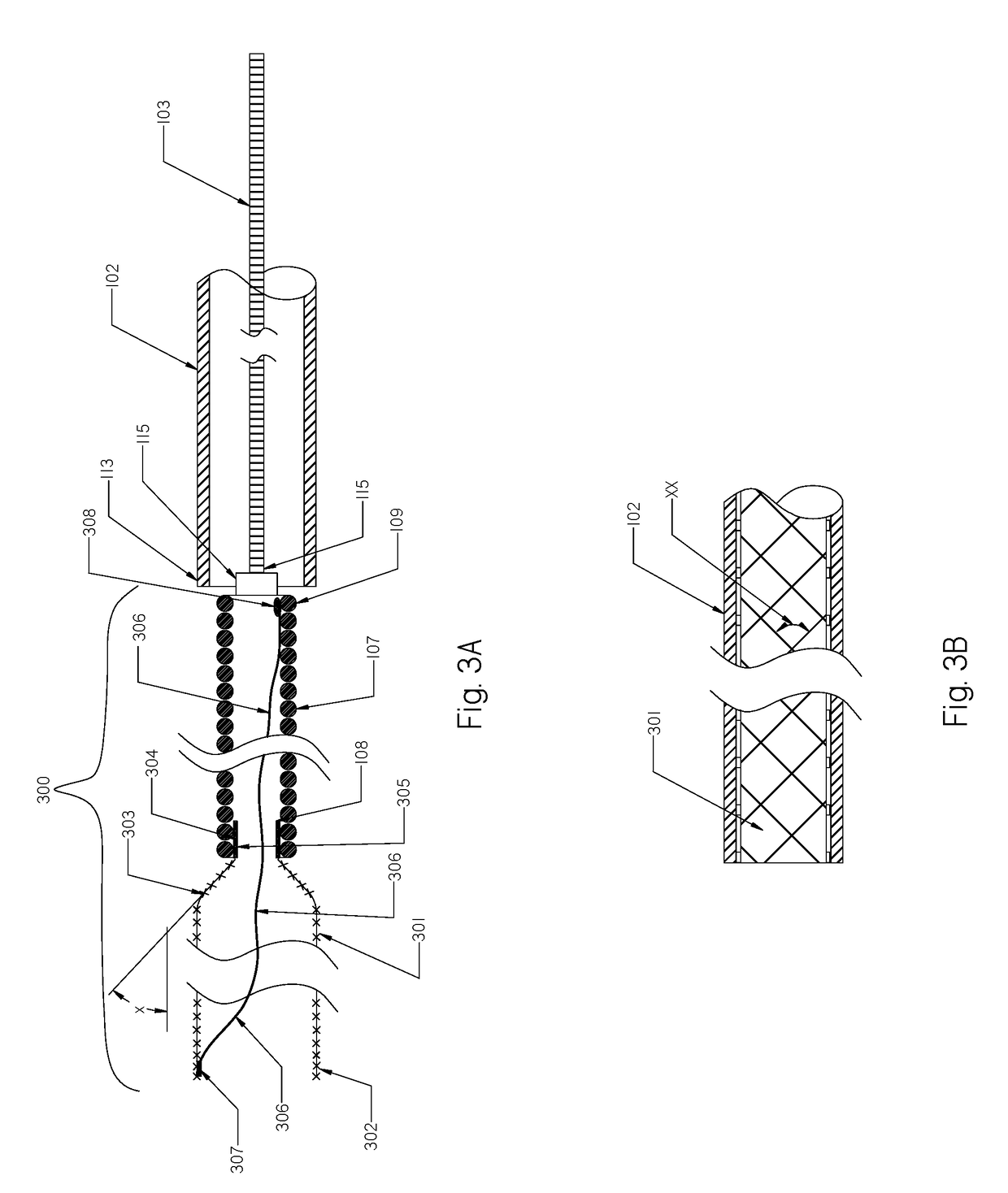 Devices and Methods for Treatment of Endovascular and Non-Endovascular Defects in Humans Using Tandem Embolization Devices