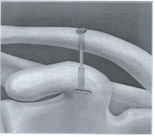 Device for reconstructing coracoclavicular ligament