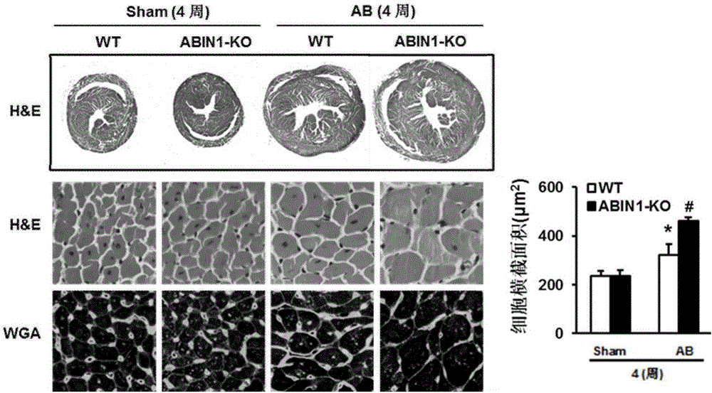 Function and application of A20 combined nuclear factor profilin 1(ABIN1) in cardiac hypertrophy treatment