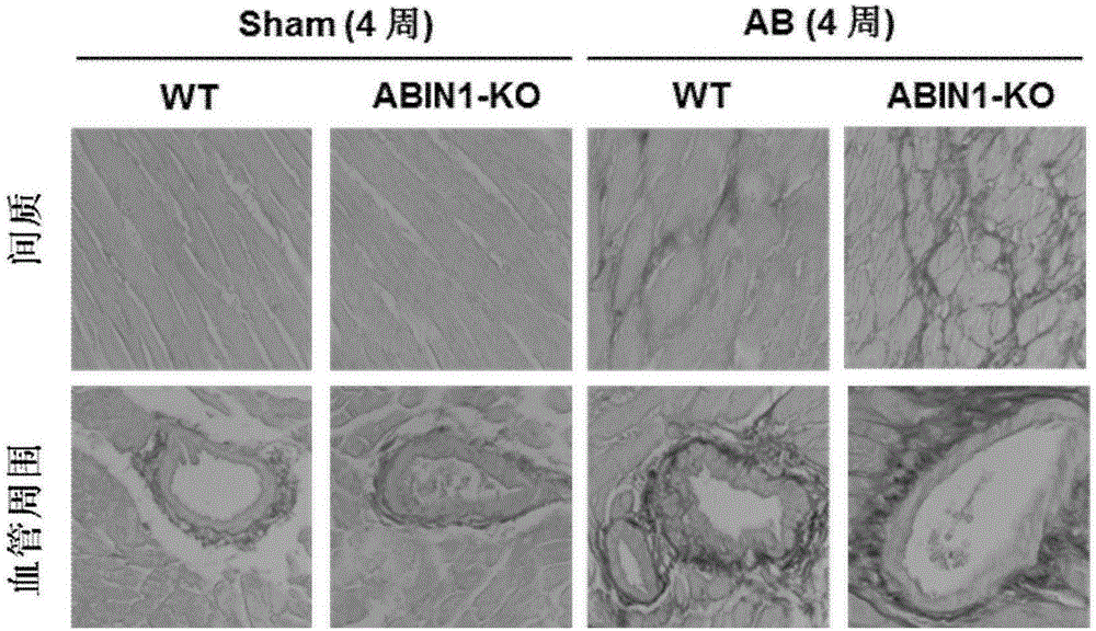 Function and application of A20 combined nuclear factor profilin 1(ABIN1) in cardiac hypertrophy treatment