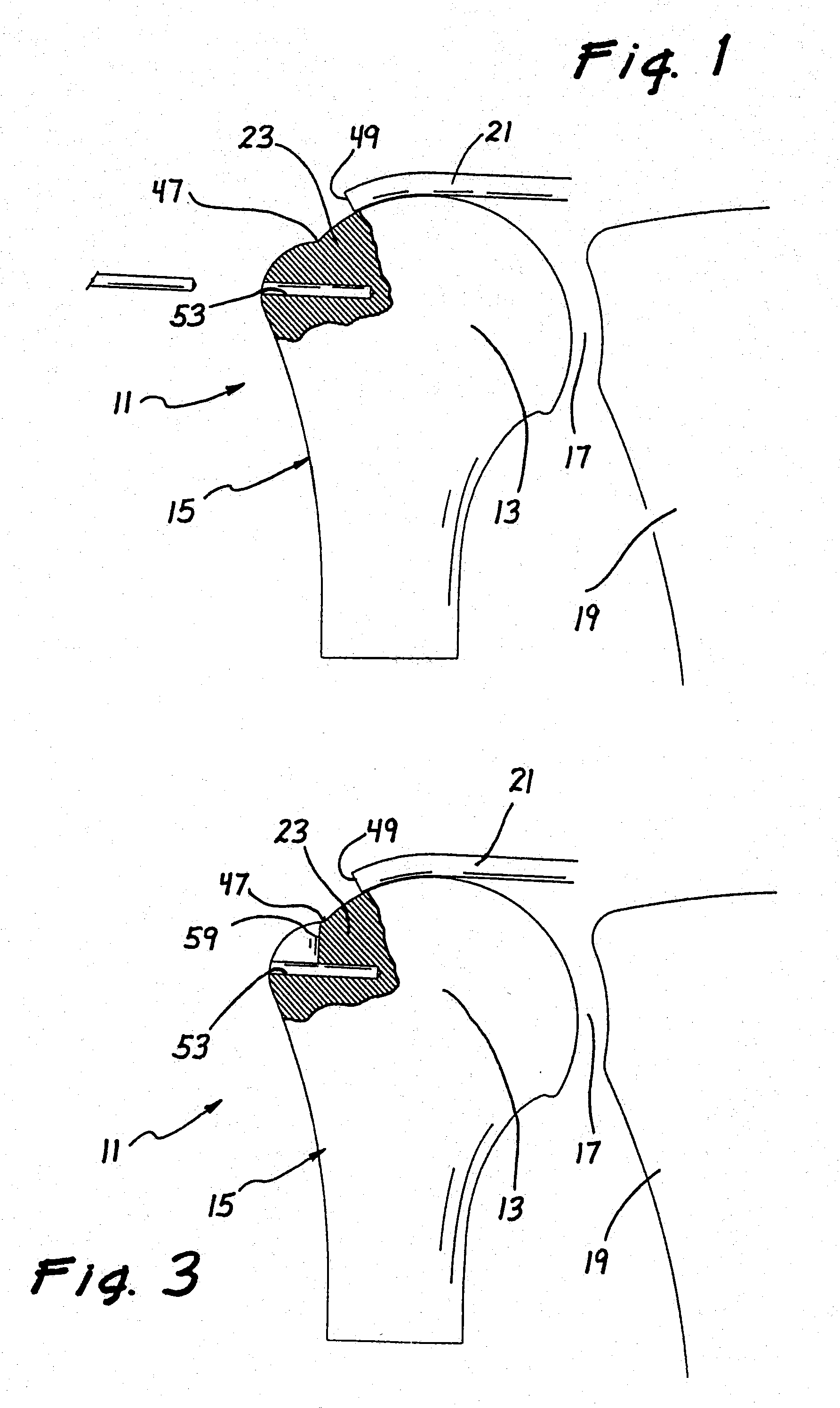 Methods for attaching connective tissues to bone using a multi-component anchor