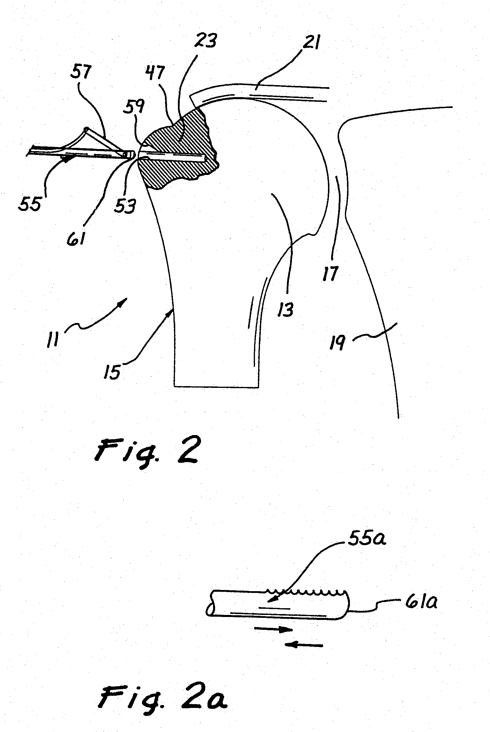 Methods for attaching connective tissues to bone using a multi-component anchor