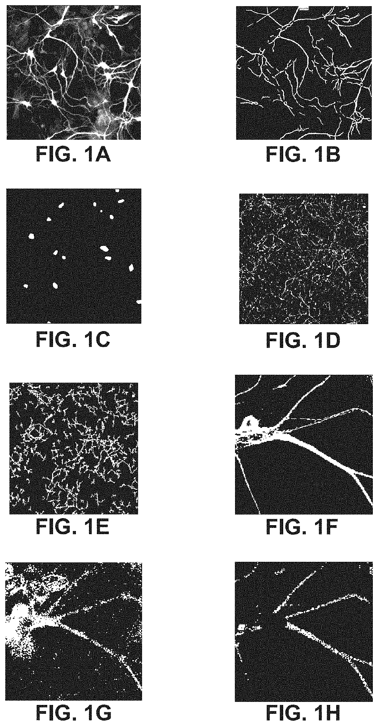 Bambuterol for the Treatment of Alzheimer's Disease