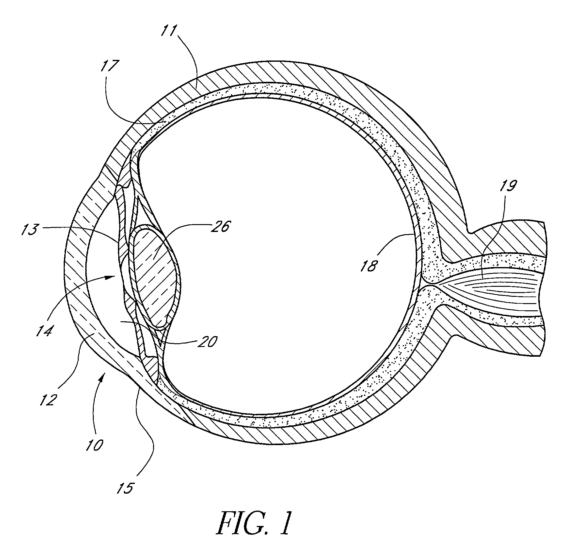 Glaucoma stent and methods thereof for glaucoma treatment