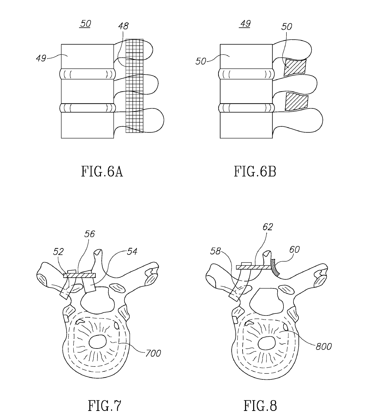 Ratcheted spinal device