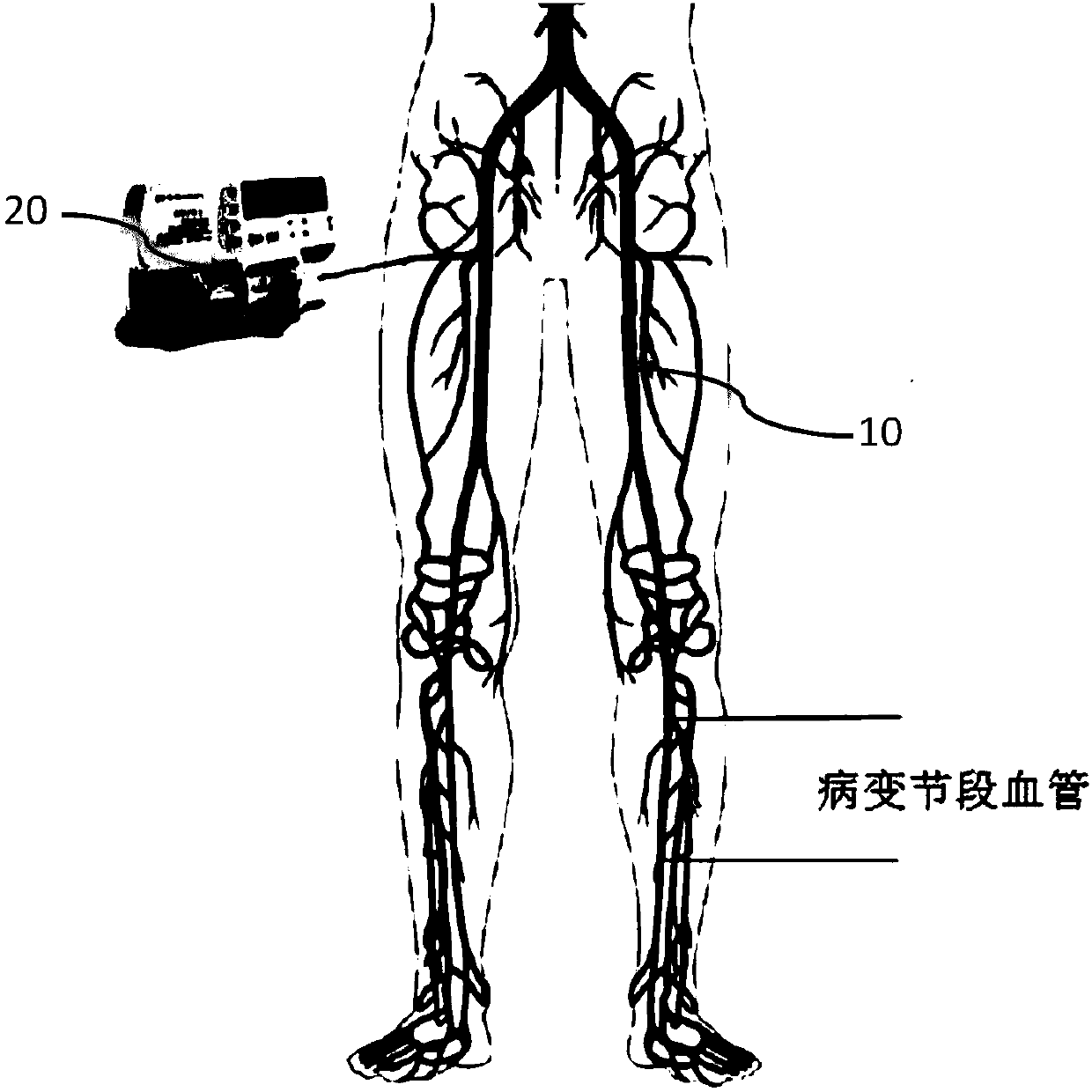 Inner-core-free thrombolytic catheter