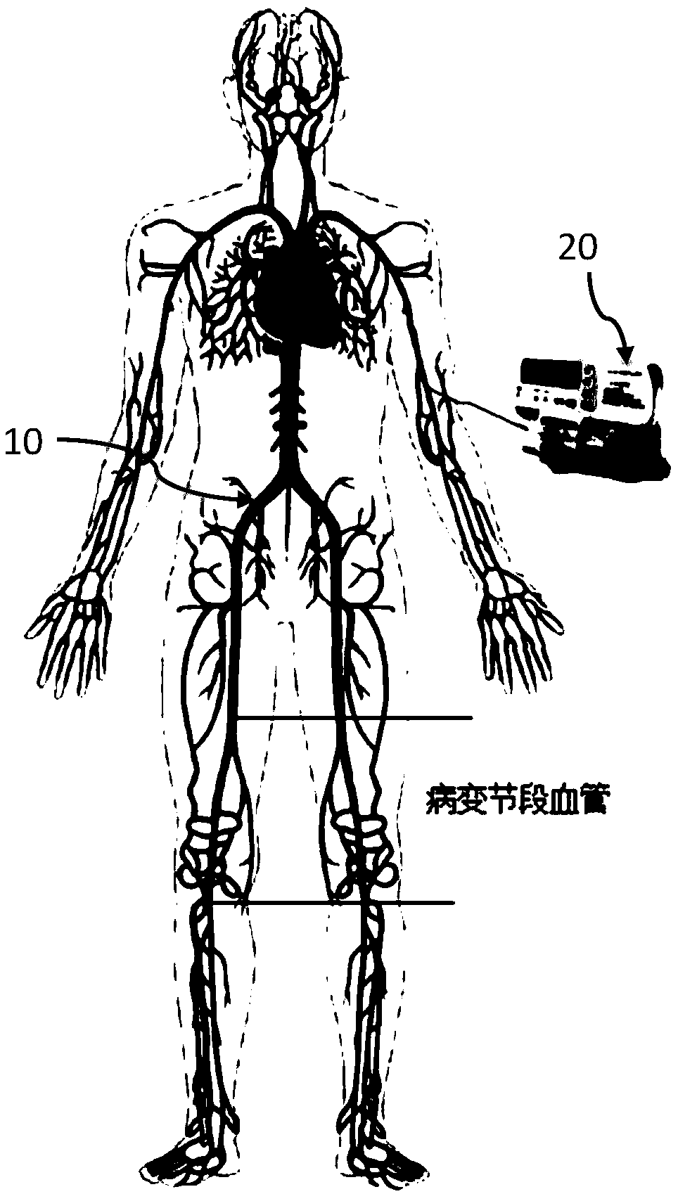 Inner-core-free thrombolytic catheter