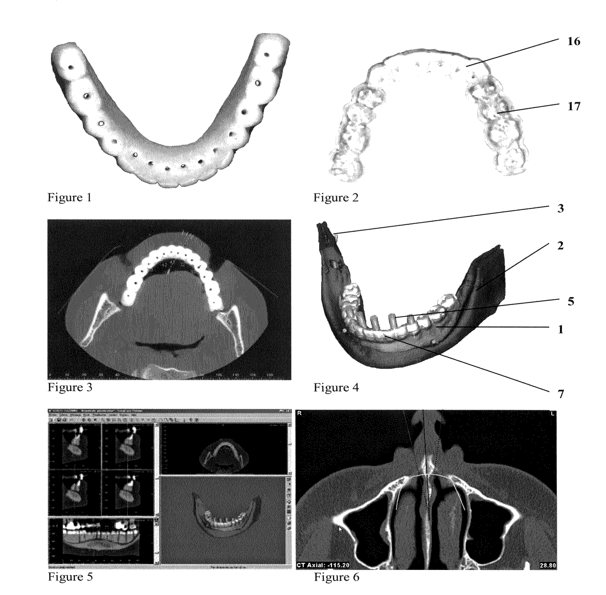 Method for (semi-) automatic dental implant planning