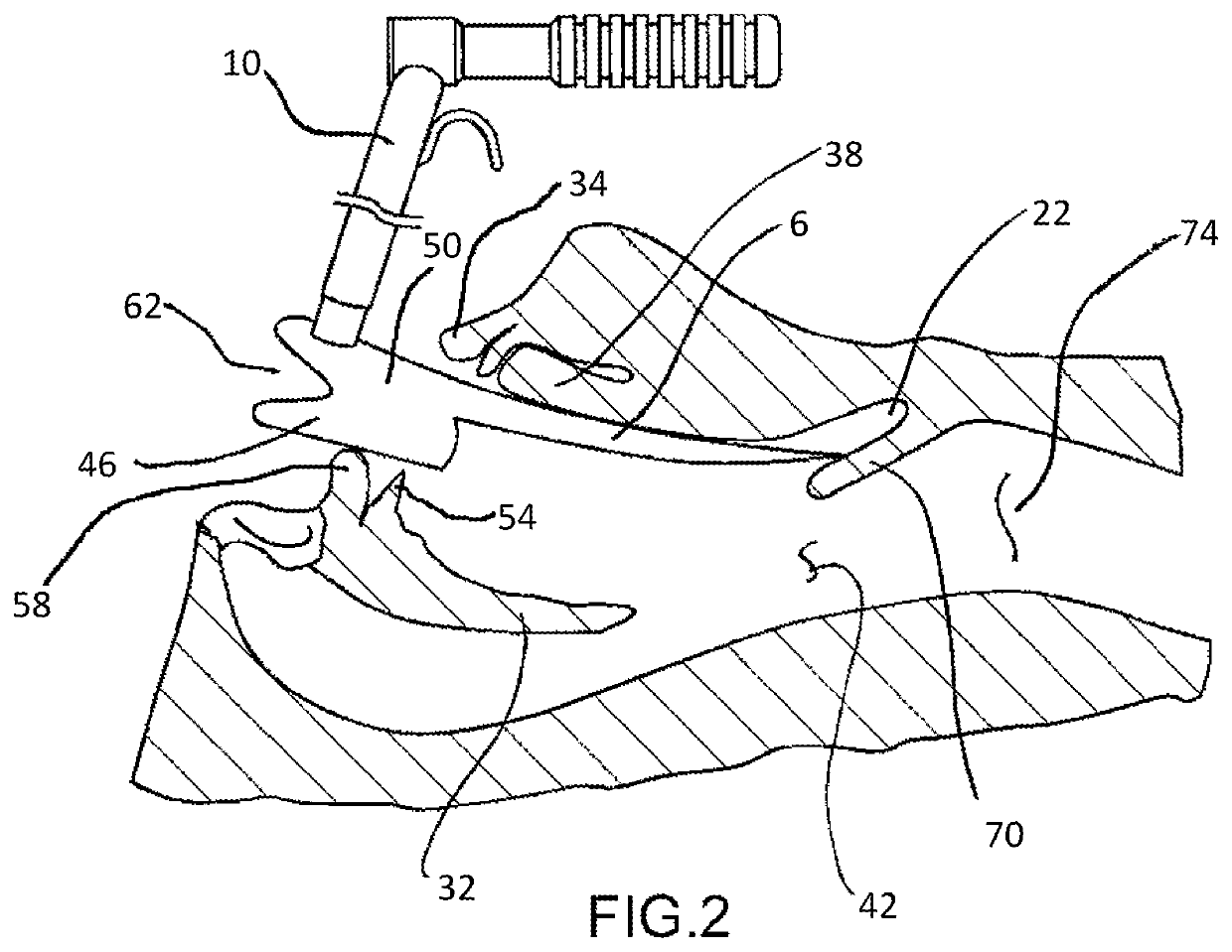 Retractor and tip extender therefor