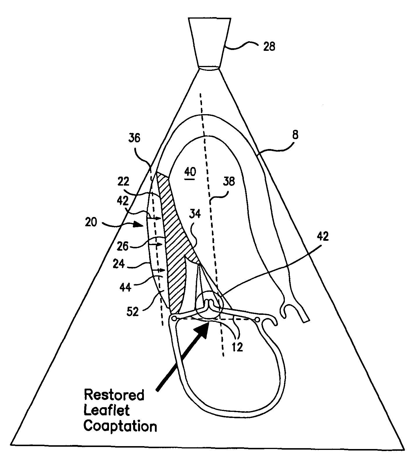 Systems for and methods of repair of atrioventricular valve regurgitation and reversing ventricular remodeling