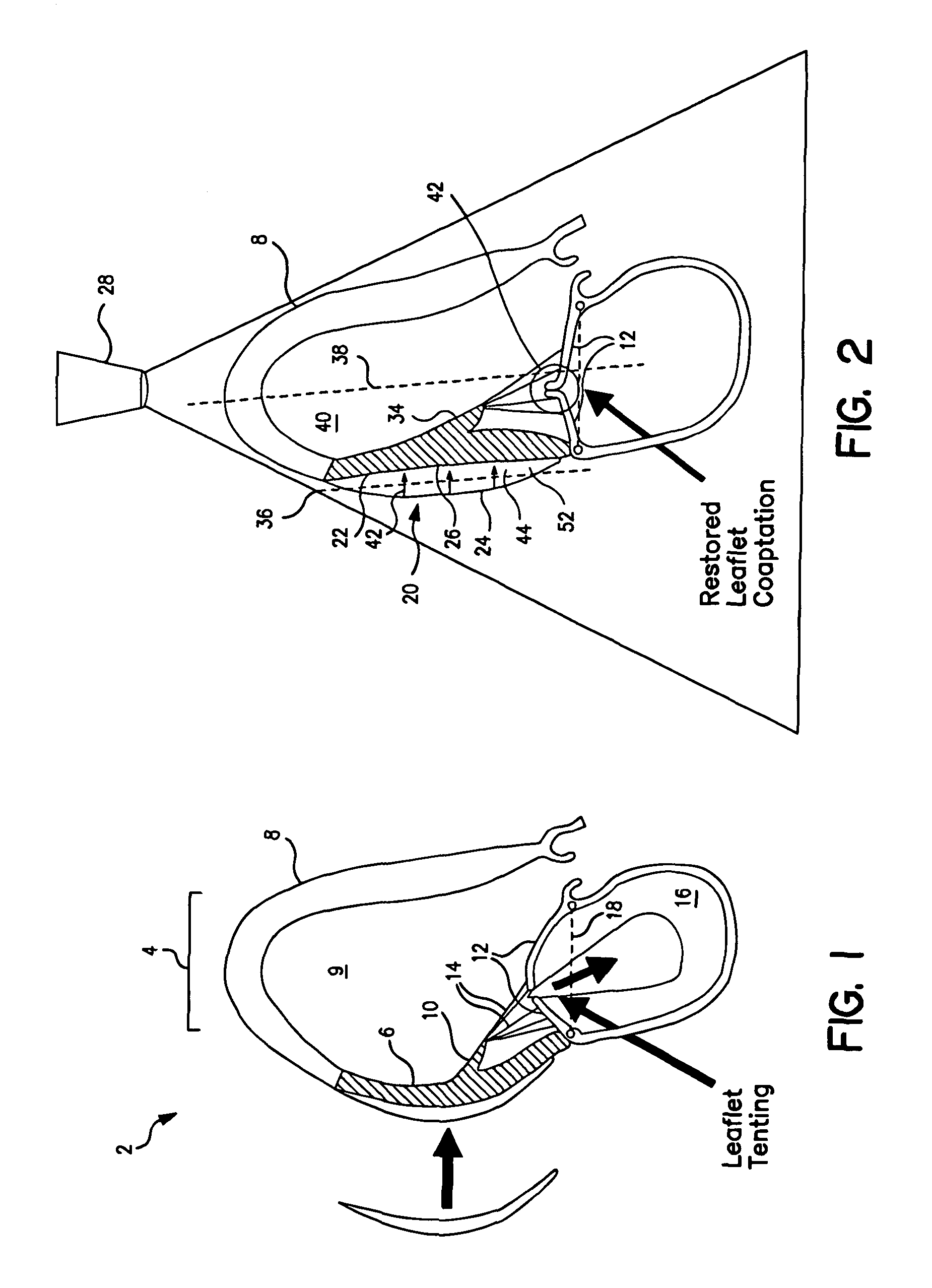 Systems for and methods of repair of atrioventricular valve regurgitation and reversing ventricular remodeling