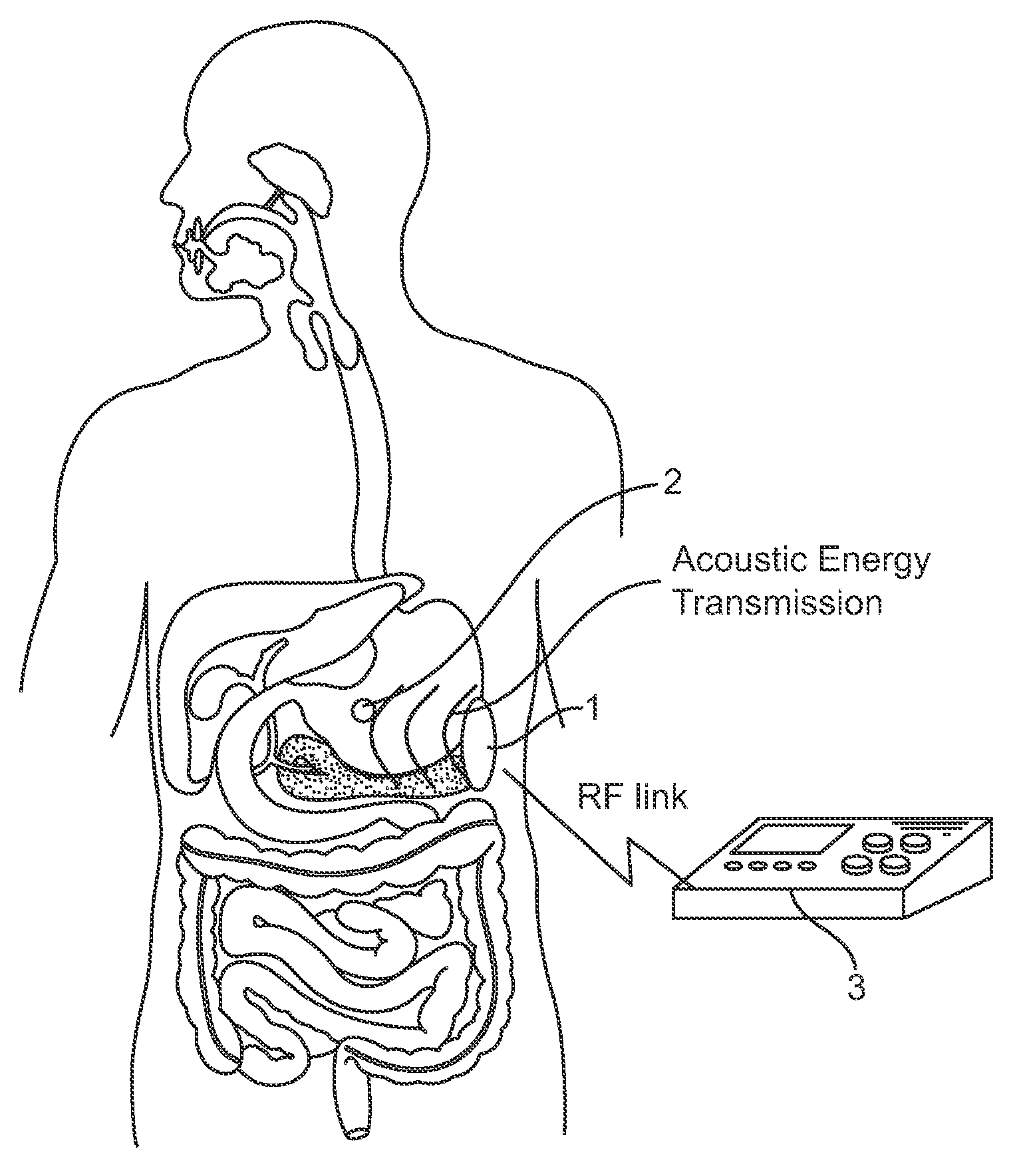 Systems and methods for implantable leadless gastrointestinal tissue stimulation