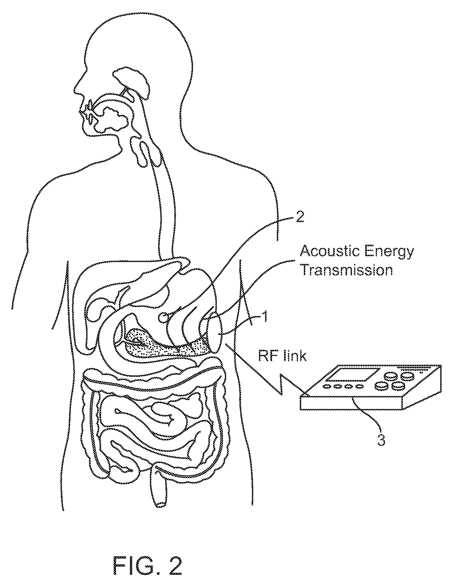 Systems and methods for implantable leadless gastrointestinal tissue stimulation