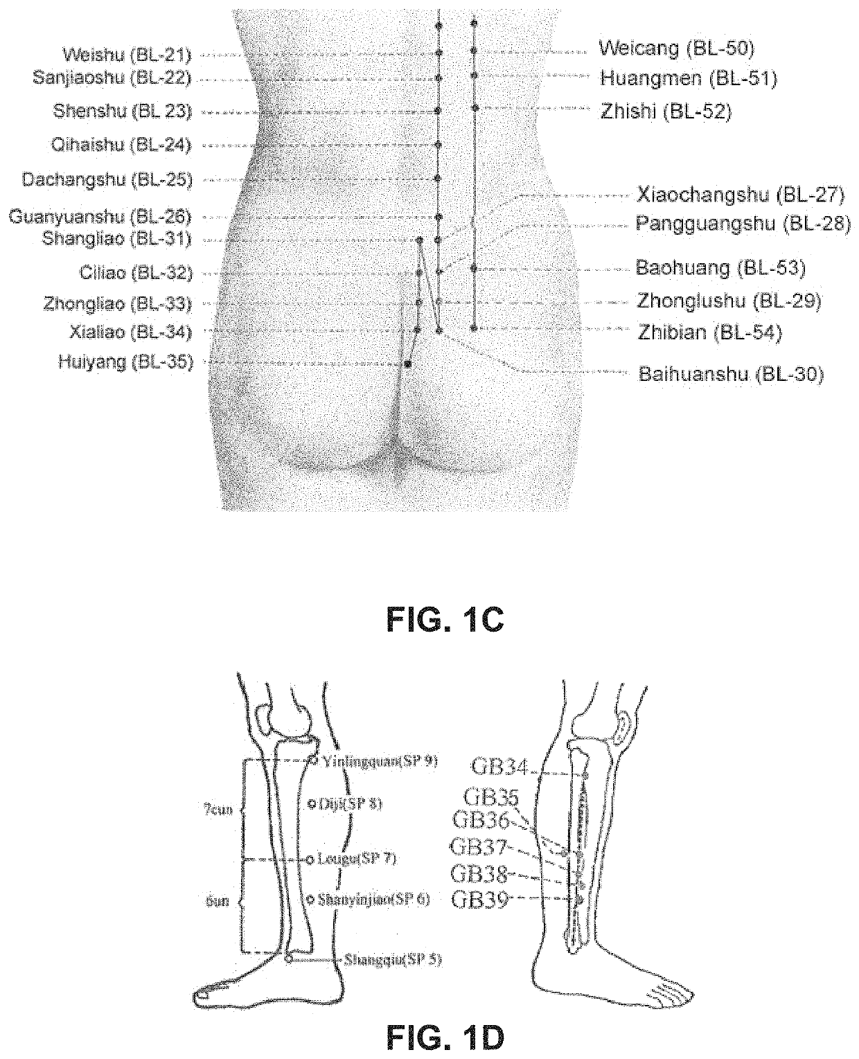 Systems, methods and devices for peripheral neuromodulation for treating diseases related to overactive bladder
