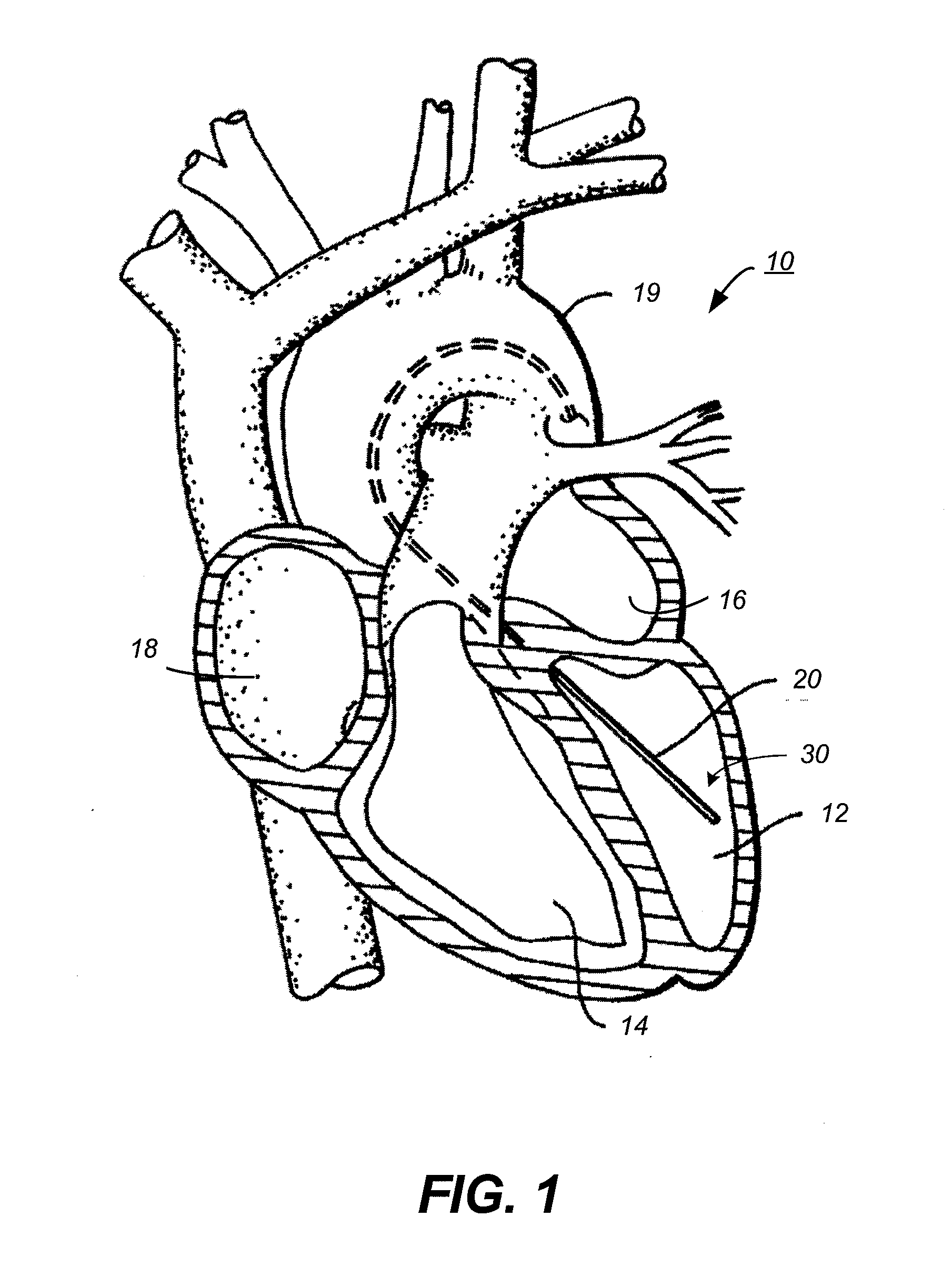 Catheter and Method for Improved Ablation
