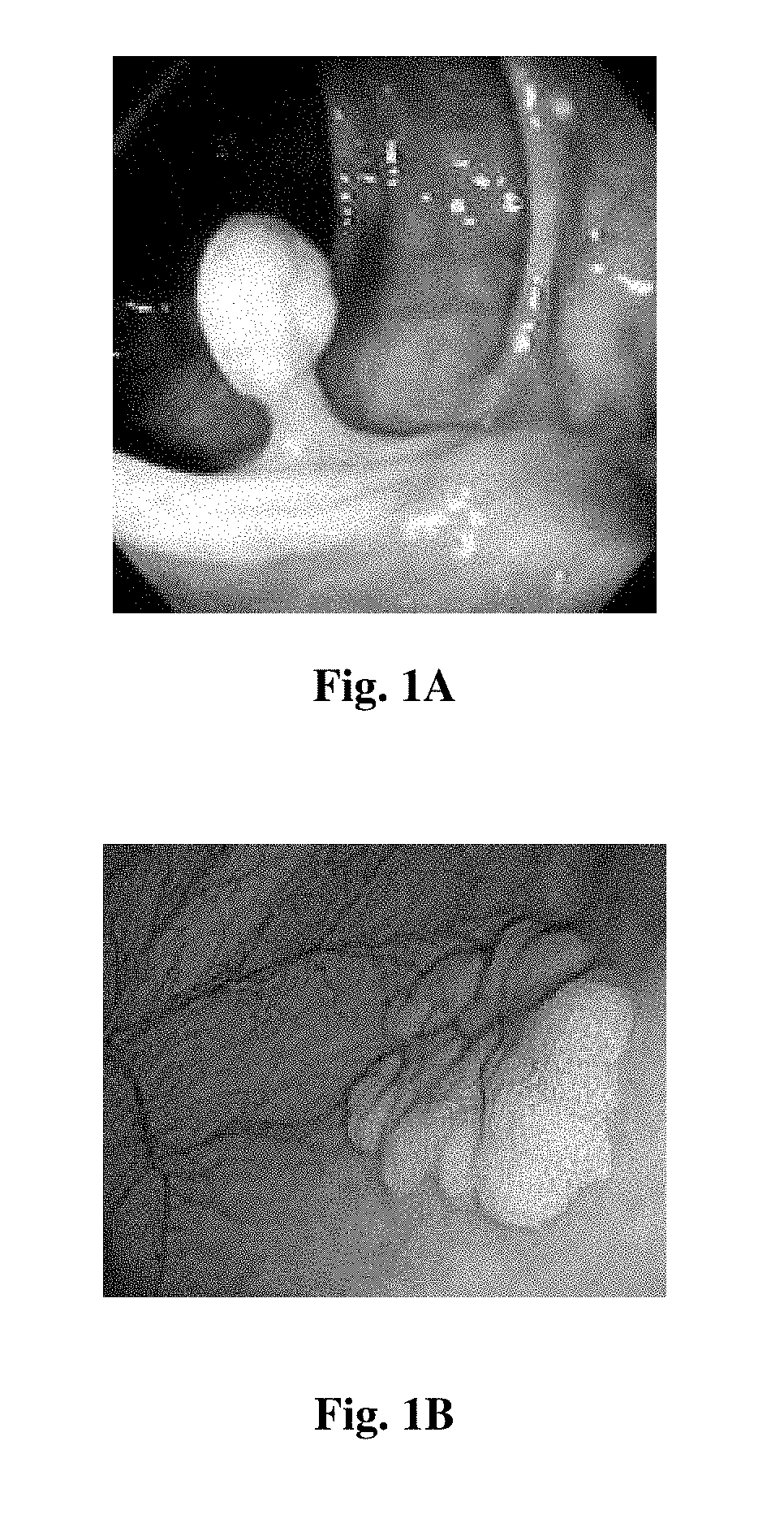 A system and method for detection of suspicious tissue regions in an endoscopic procedure