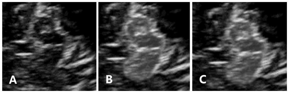 Quantitative analysis method of substantia nigra hyperechoic intensity by transcranial ultrasound