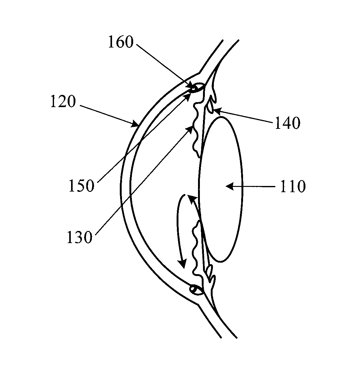 Pulsed Electric Field Probe for Glaucoma Surgery