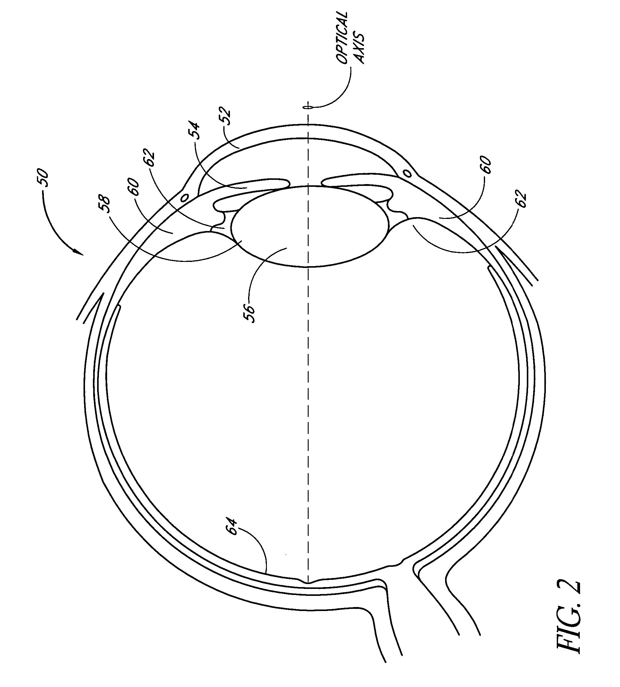 Method of implanting an intraocular lens