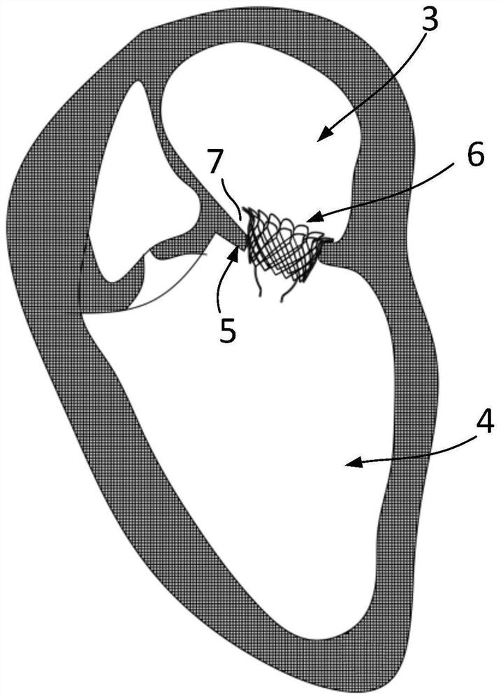 Mitral valve interventional valve and delivery system