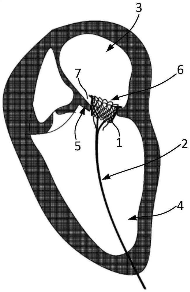 Mitral valve interventional valve and delivery system