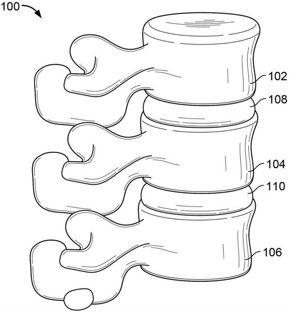 Prosthetic spinal disk nucleus