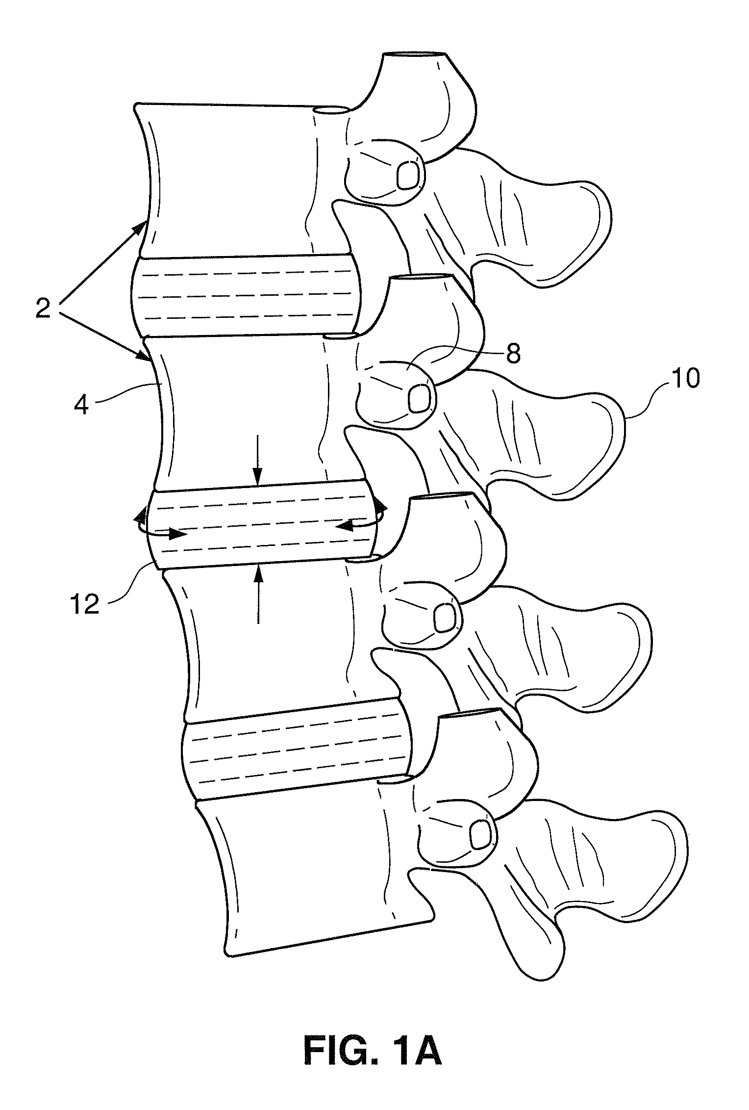 Spinal implant and method for restricting spinal flexion