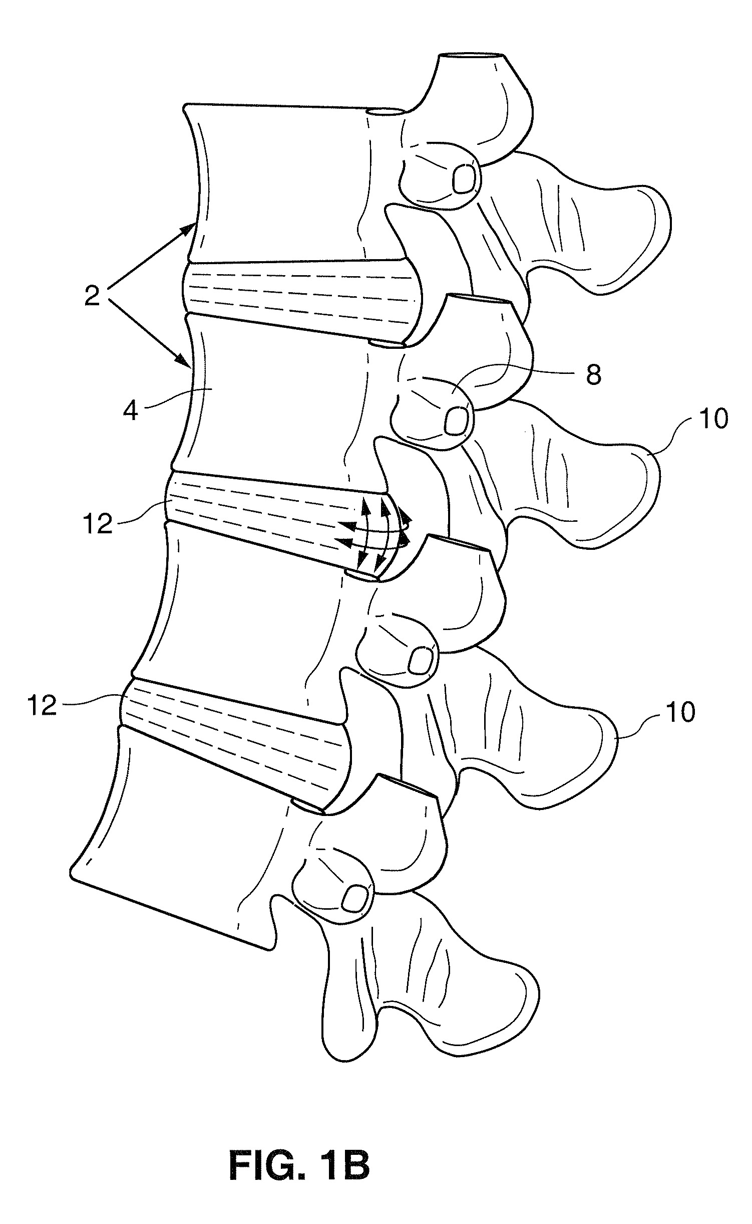 Spinal implant and method for restricting spinal flexion