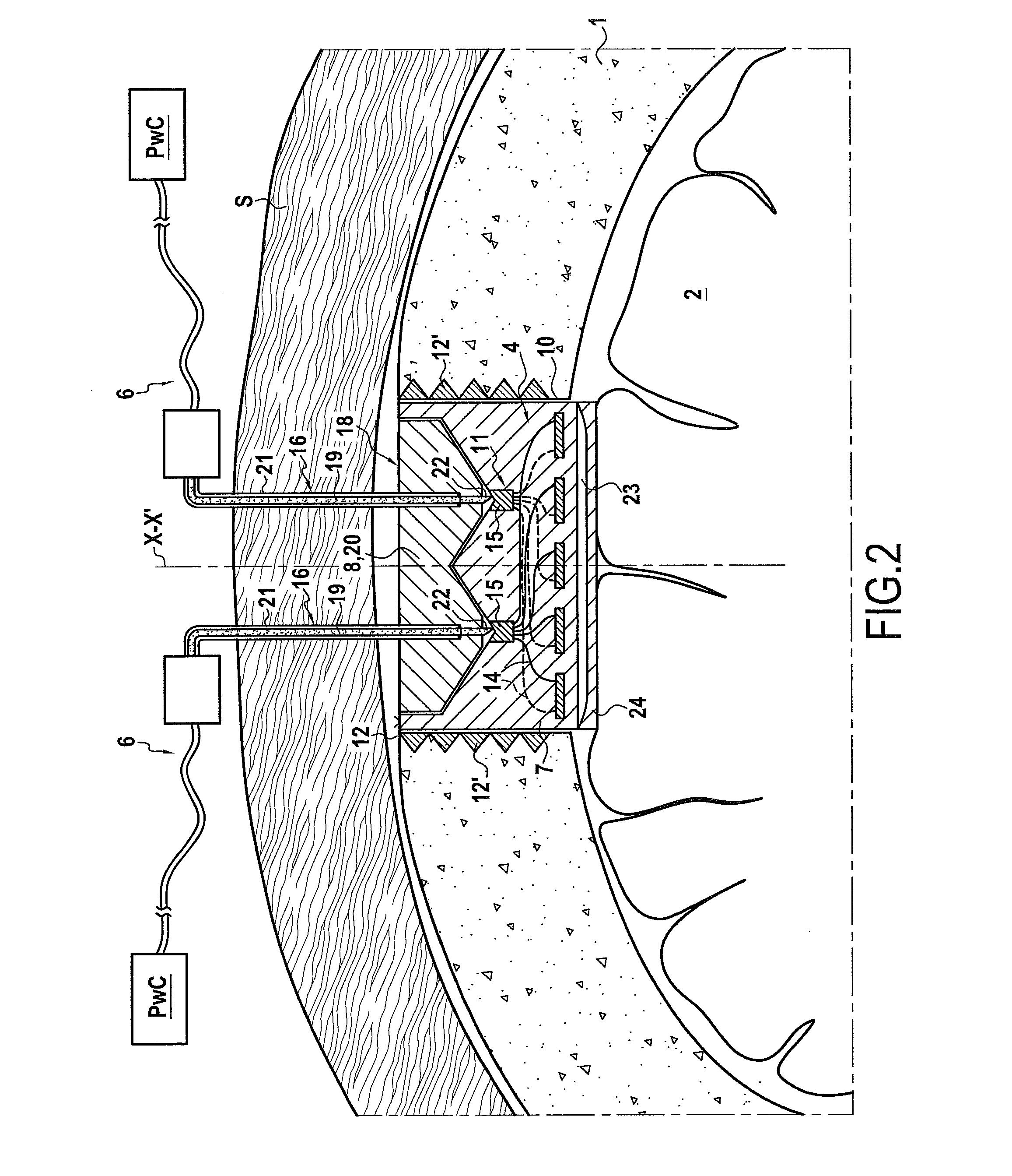 Apparatus for the treatment of brain affections and method implementing thereof