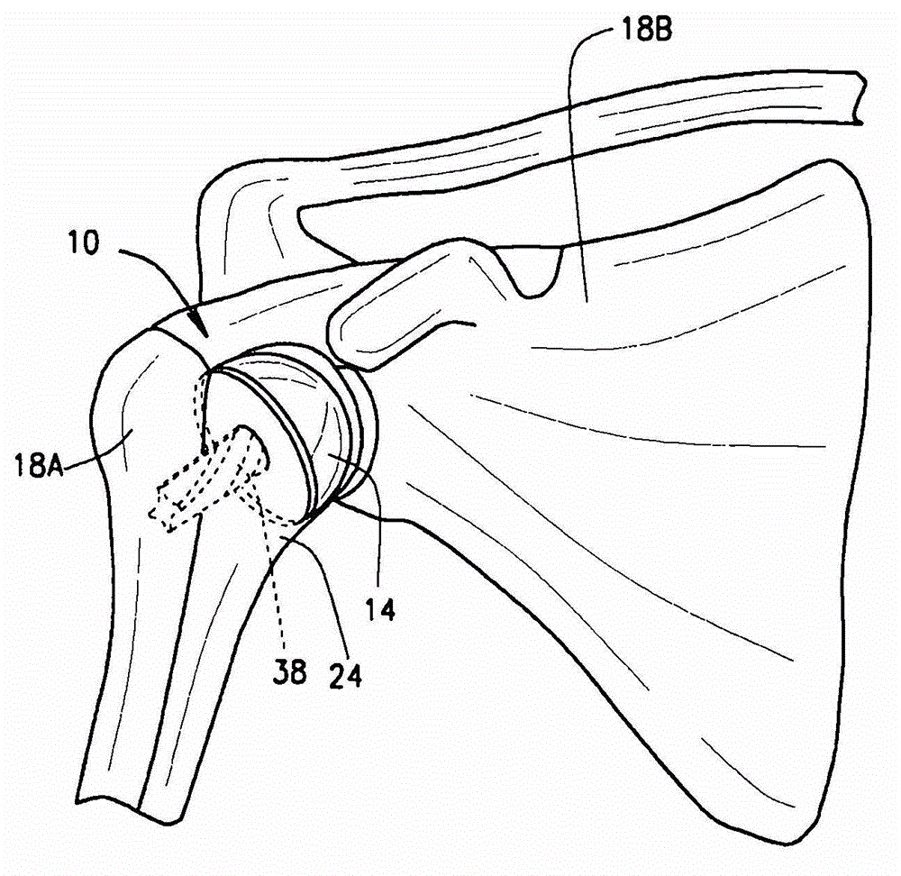 Joint implant and prosthesis and method