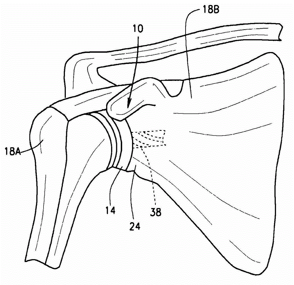 Joint implant and prosthesis and method