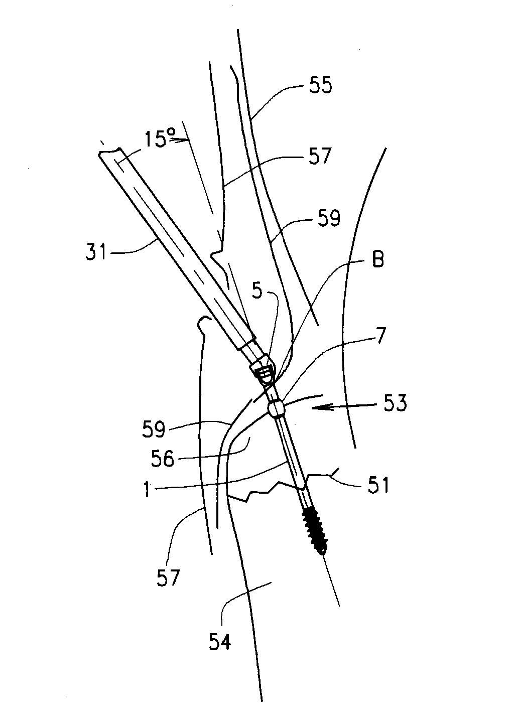 Minimal incision removable bone screw, driver, and method of use