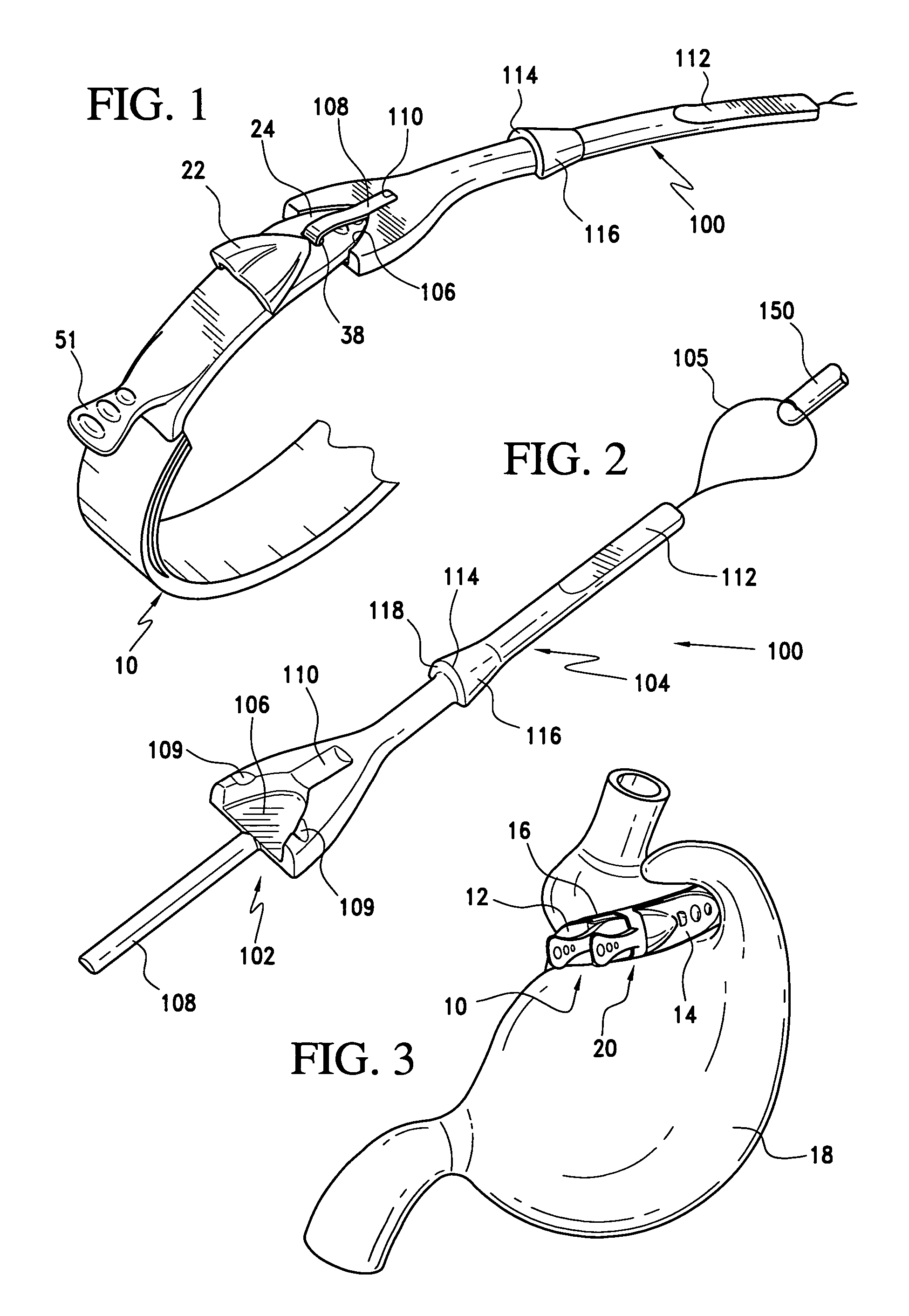 Method of implating a medical device using a suture tab extender