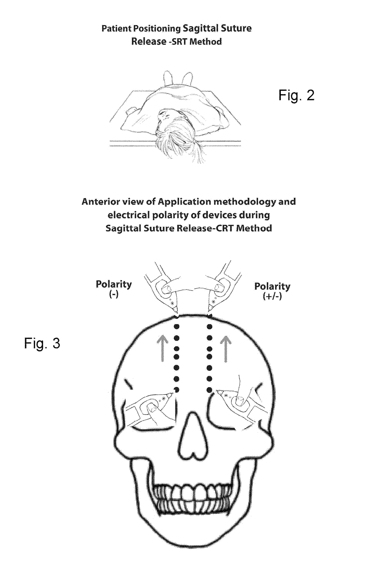 Method and system for cranial suture release